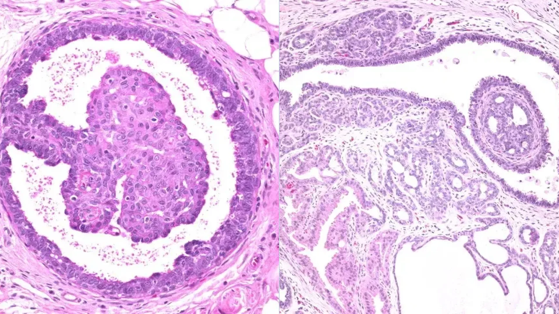Morphological presentation of intraductal papilloma