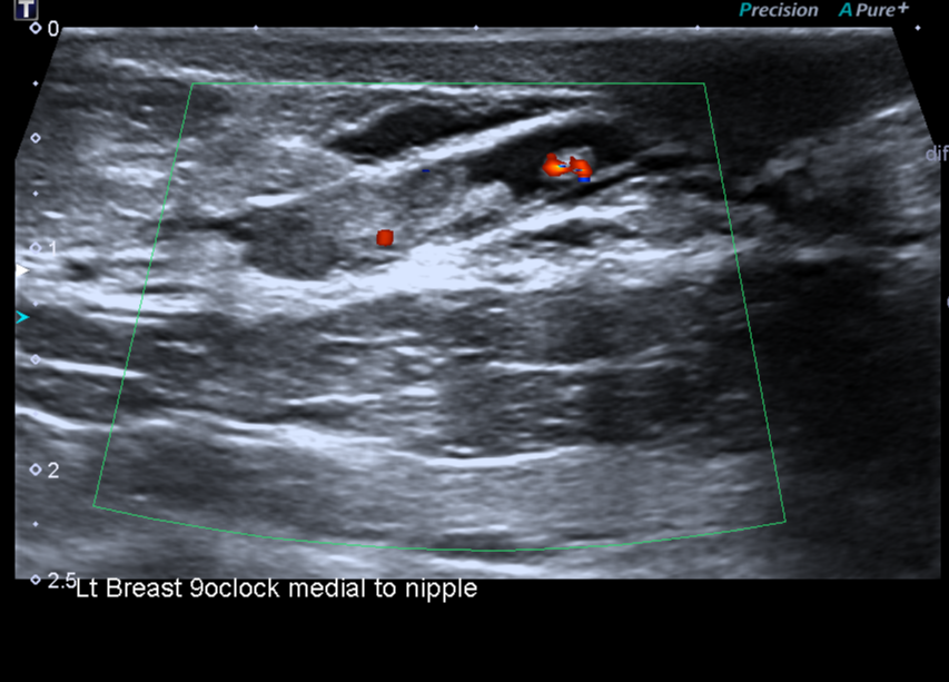 Intraductal papilloma on ultrasound image