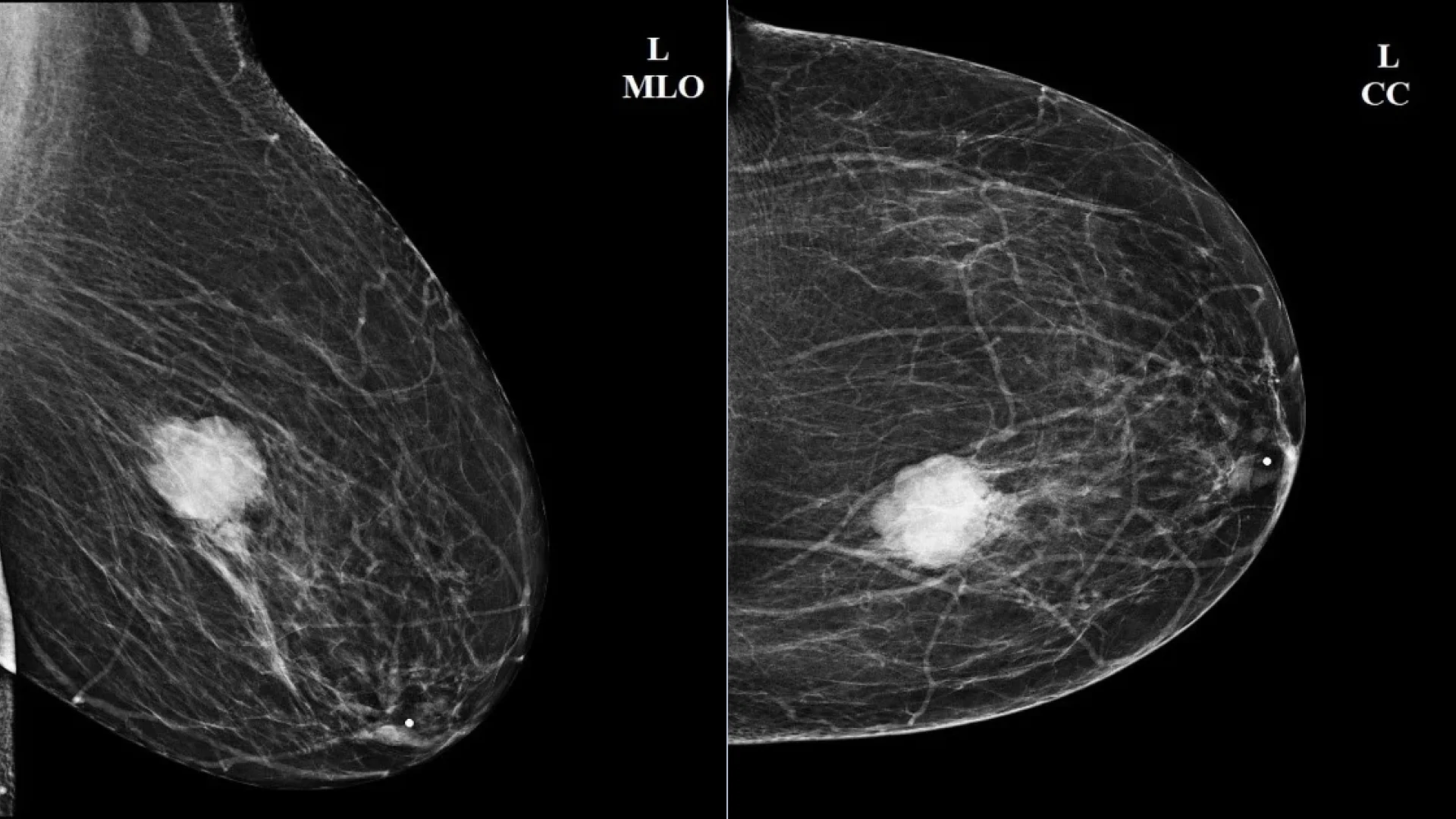 Mammography of the left breast in two projections: intraductal papilloma