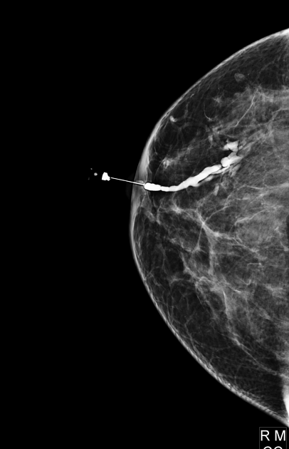 Ductography of the right breast: a filling defect typical of an intraductal papilloma is detected on the radiograph. 