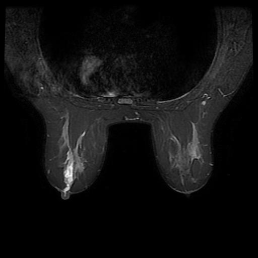  MRI picture of intraductal papilloma in T2-weighted, fat-suppressed mode. 
