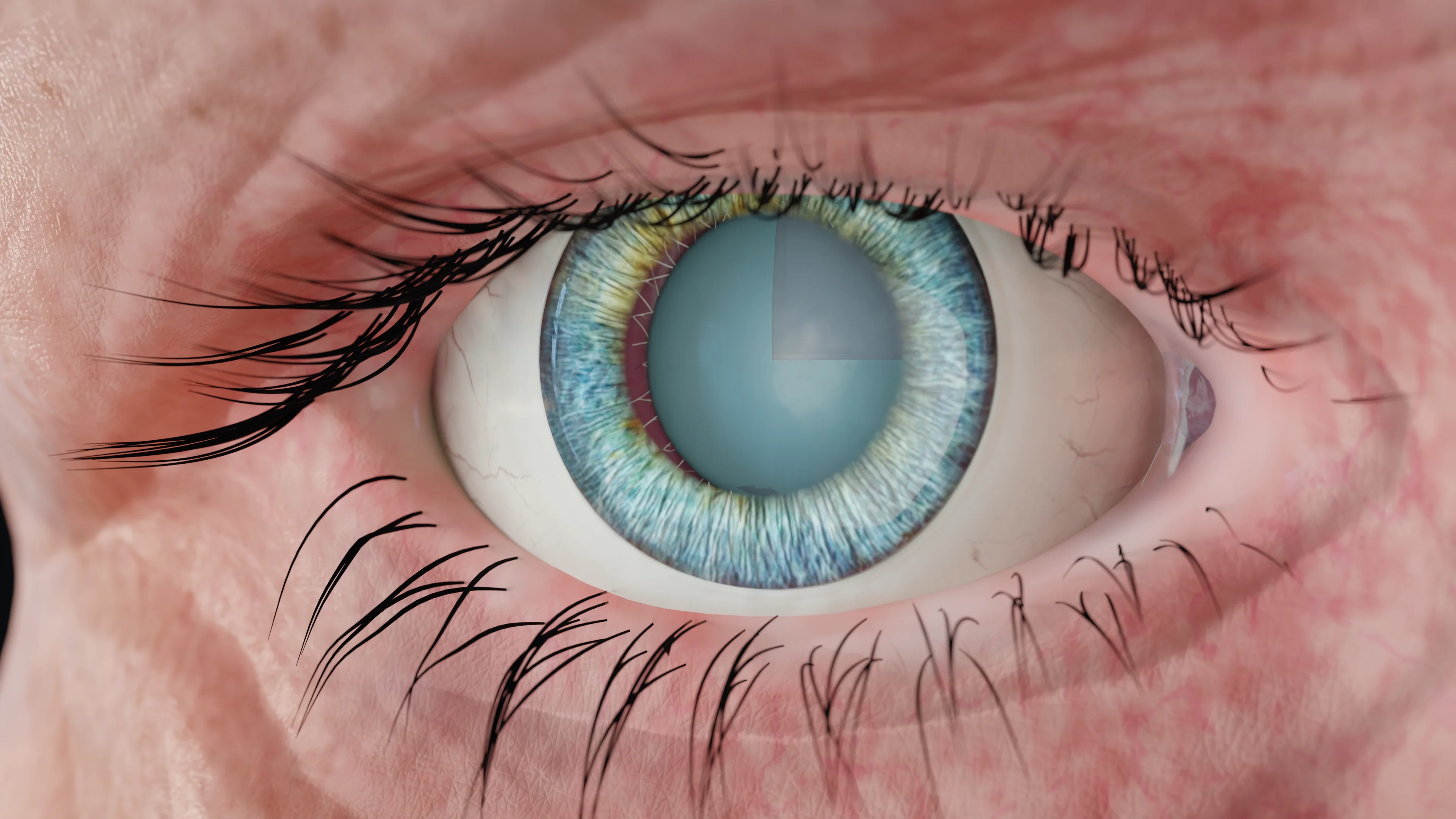 Зрелая катаракта