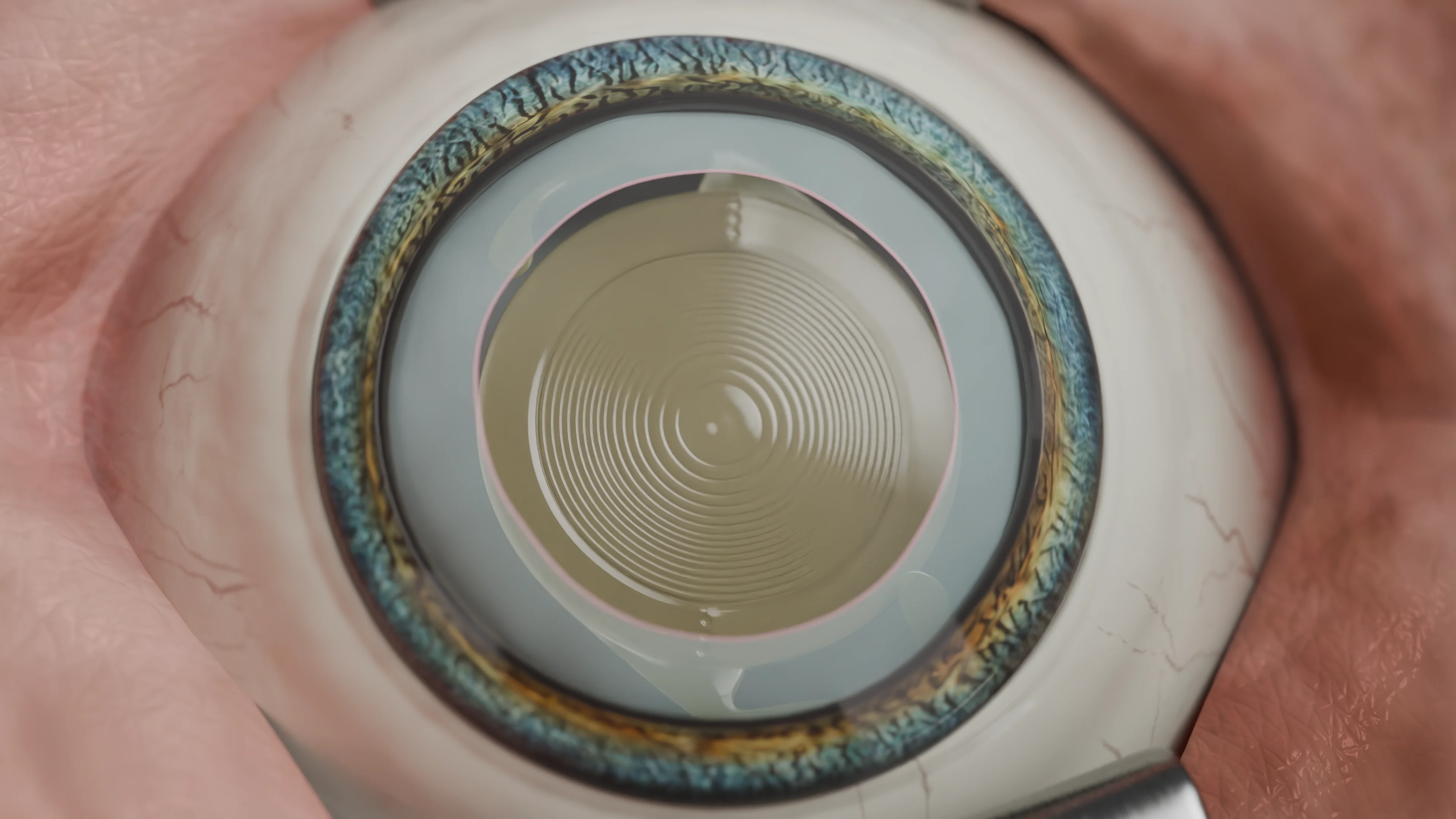 Интракапсулярная артифакия