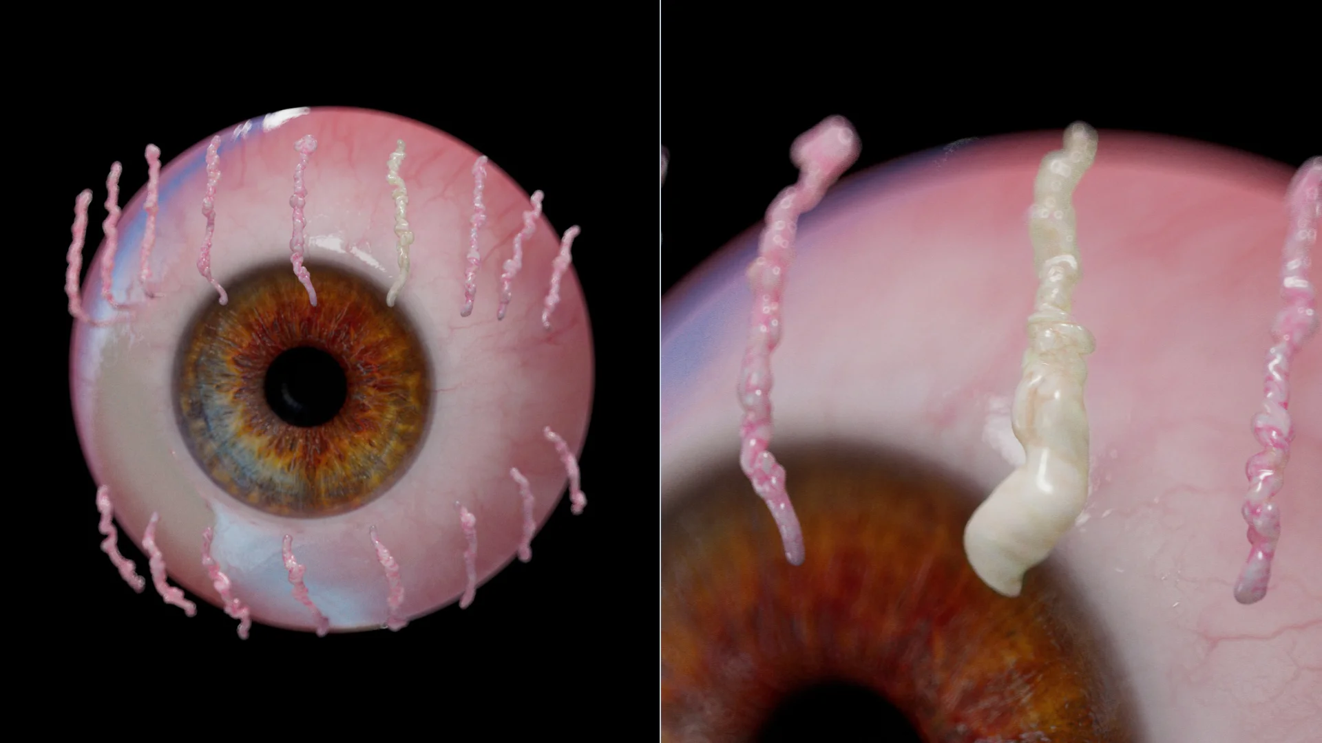 Obstrucción del conducto de la glándula de Meibomio (formación de un chalazión)