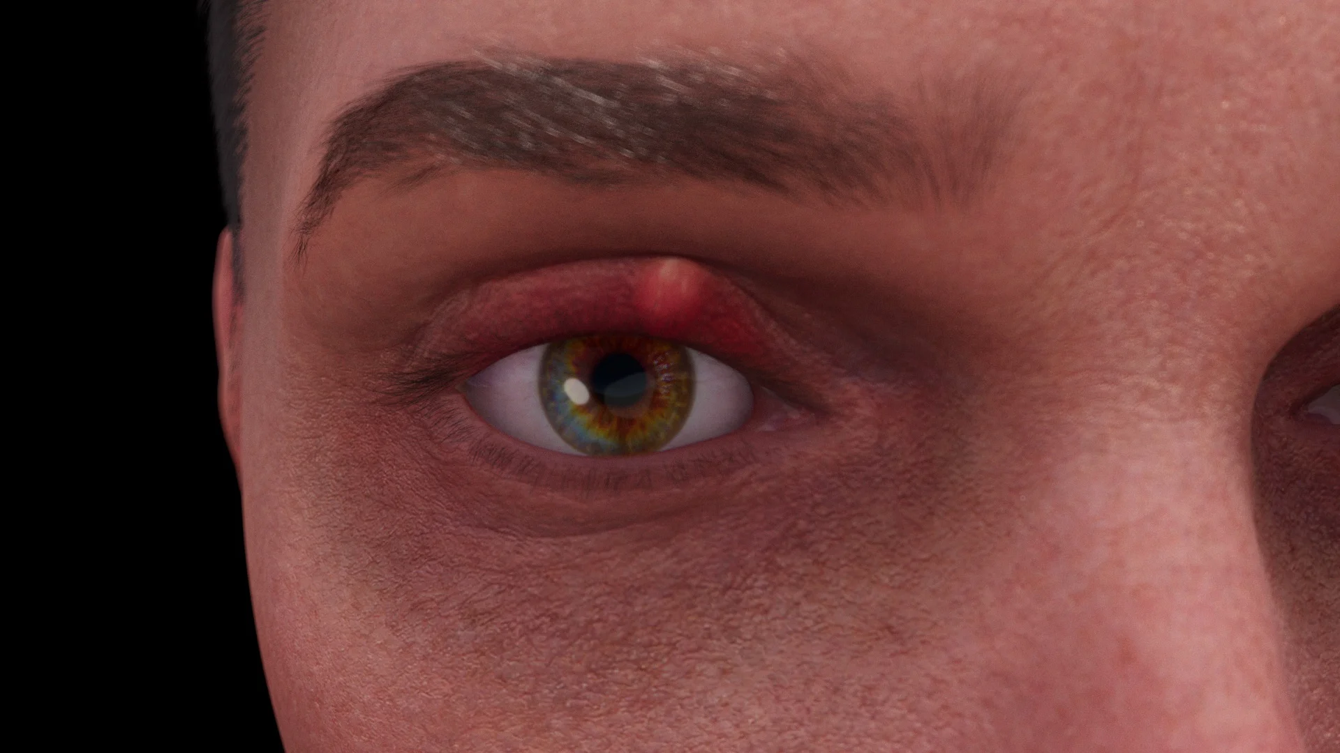 Chalazión: etiología, patogénesis, diagnóstico y métodos de tratamiento