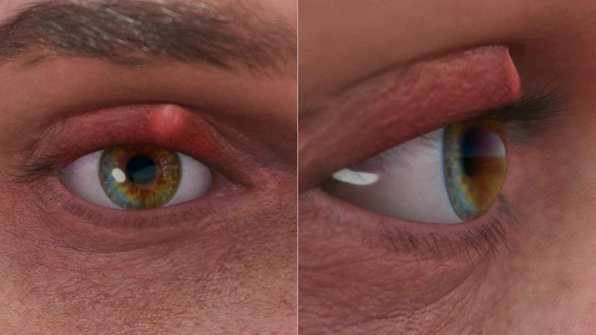 Chalazión del párpado superior