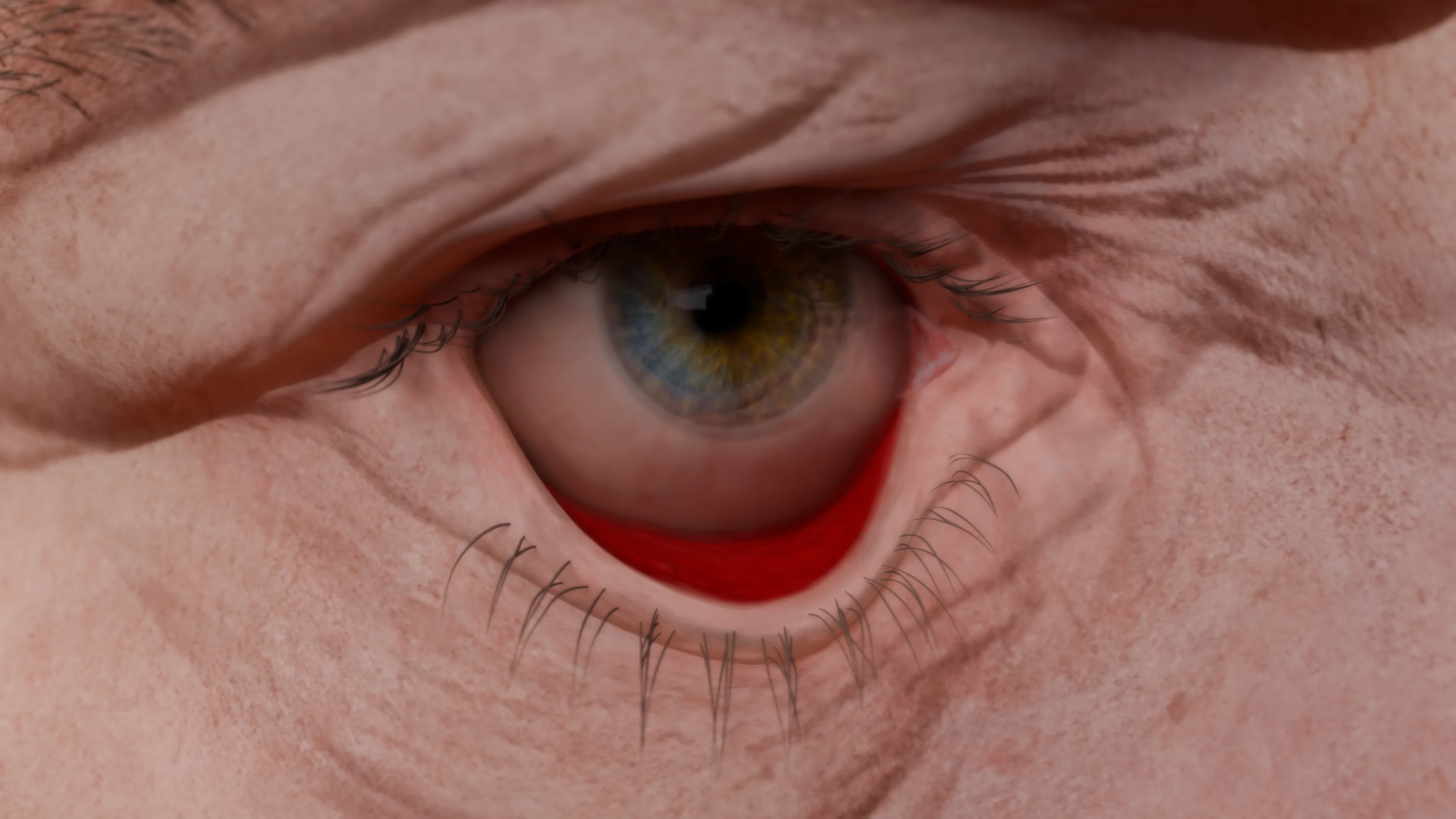 Полный выворот нижнего века (эктропион): фронтальный вид