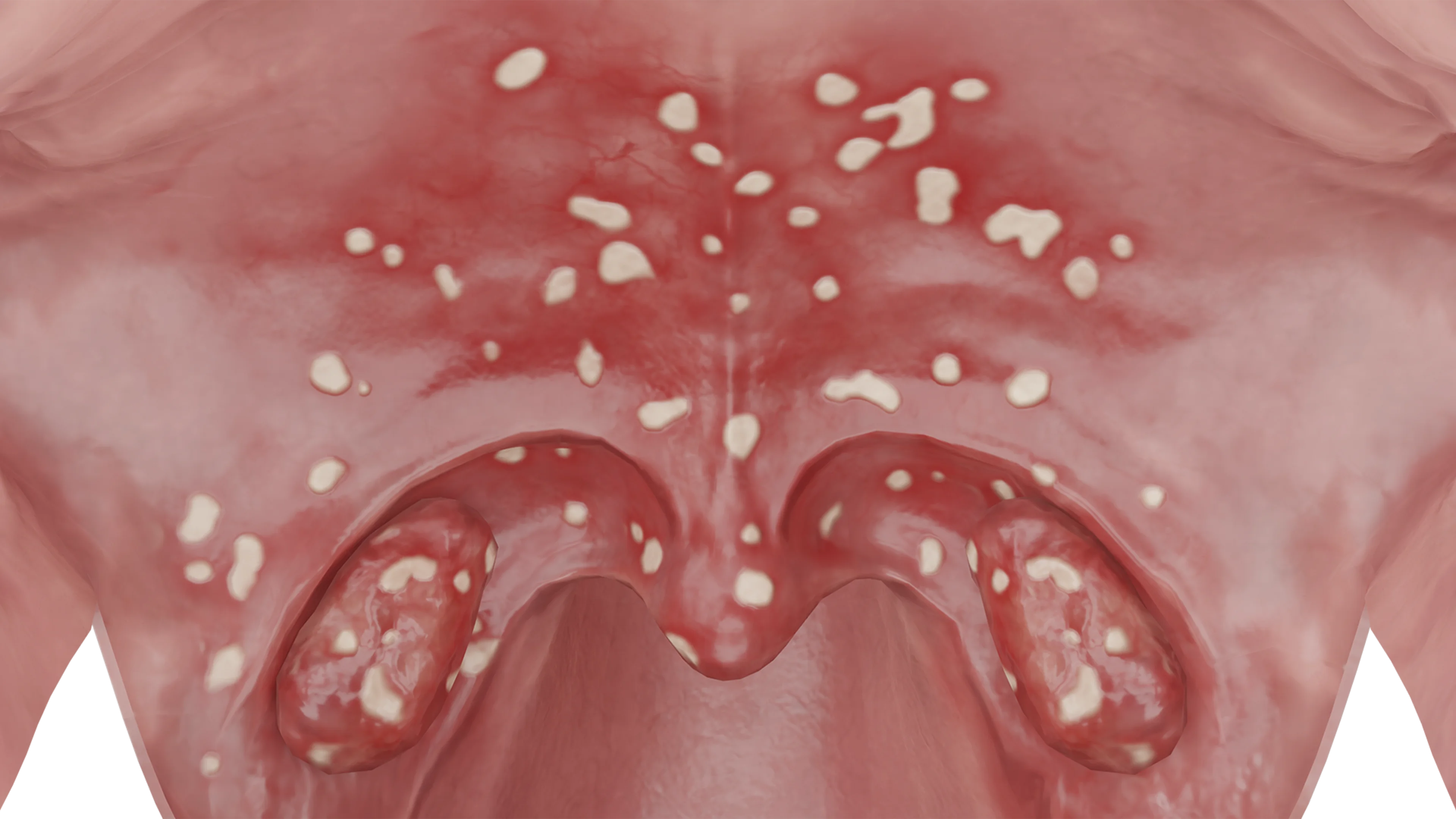 Atypical Forms of Tonsillitis: Classification, Clinical Manifestations, and Treatment