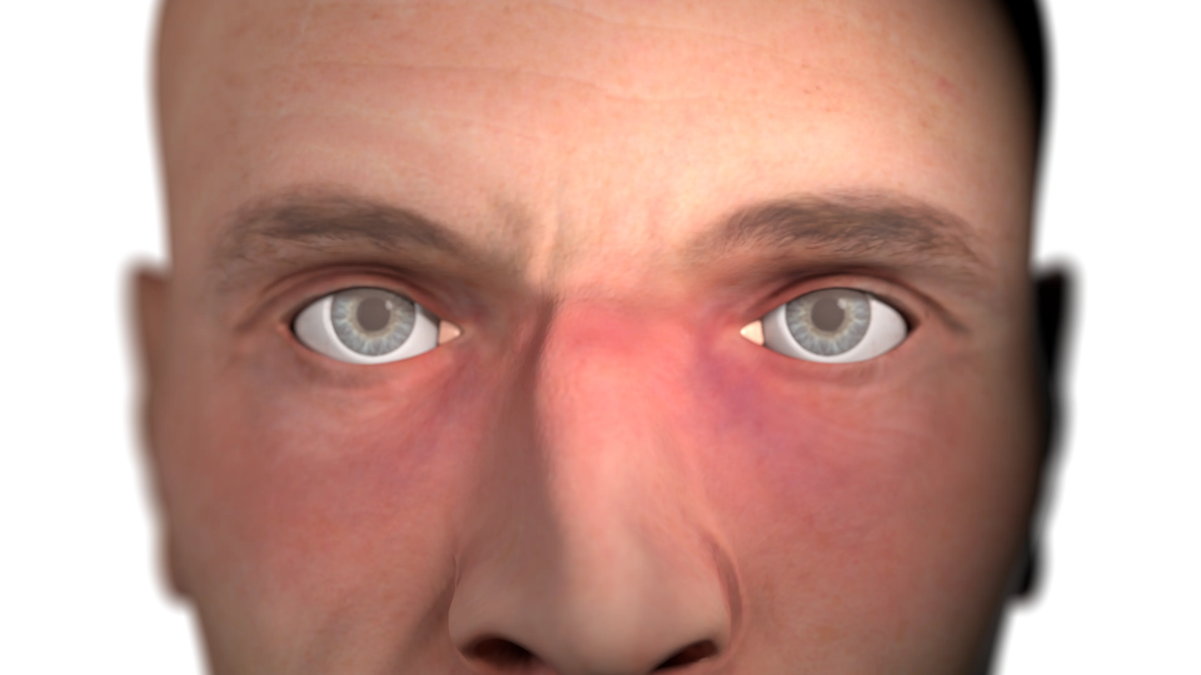 Displaced closed nasal bone fracture