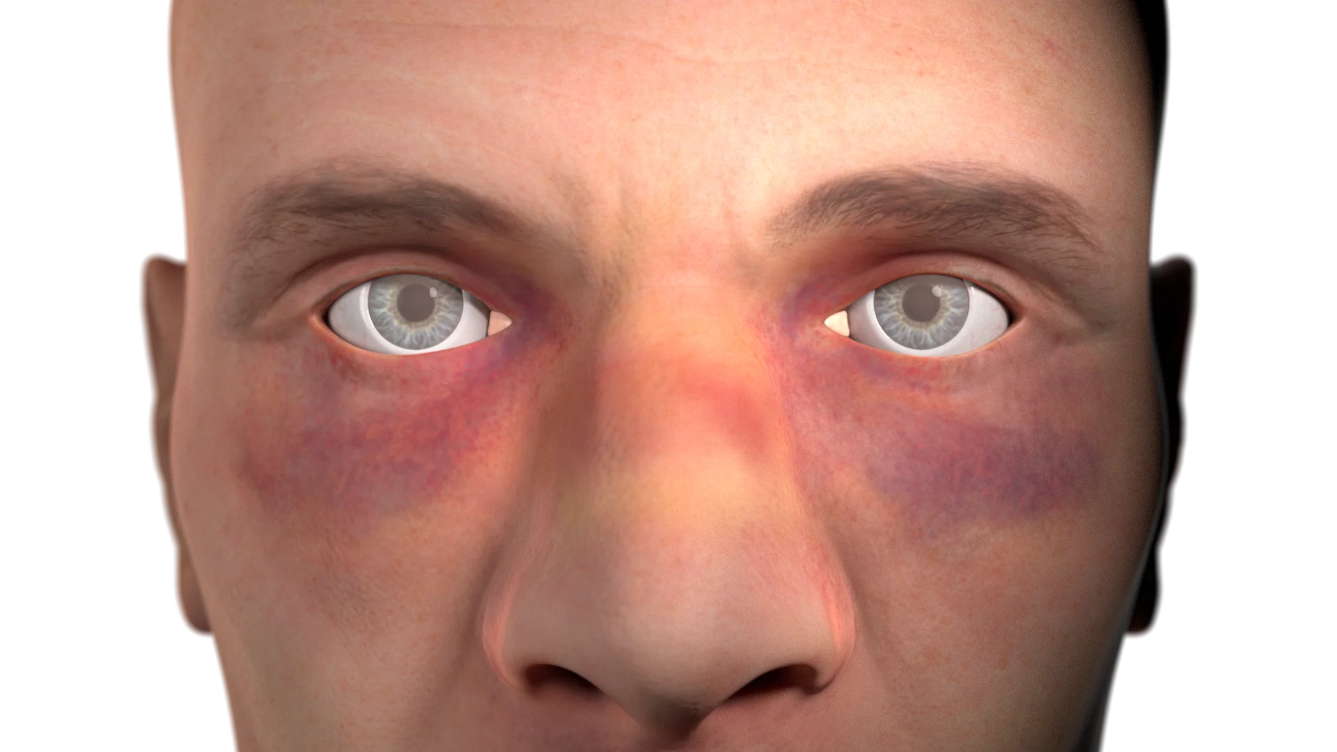 Soft Tissue Injuries of the External Nose: Etiology, Clinical Presentation, Diagnosis and Treatment