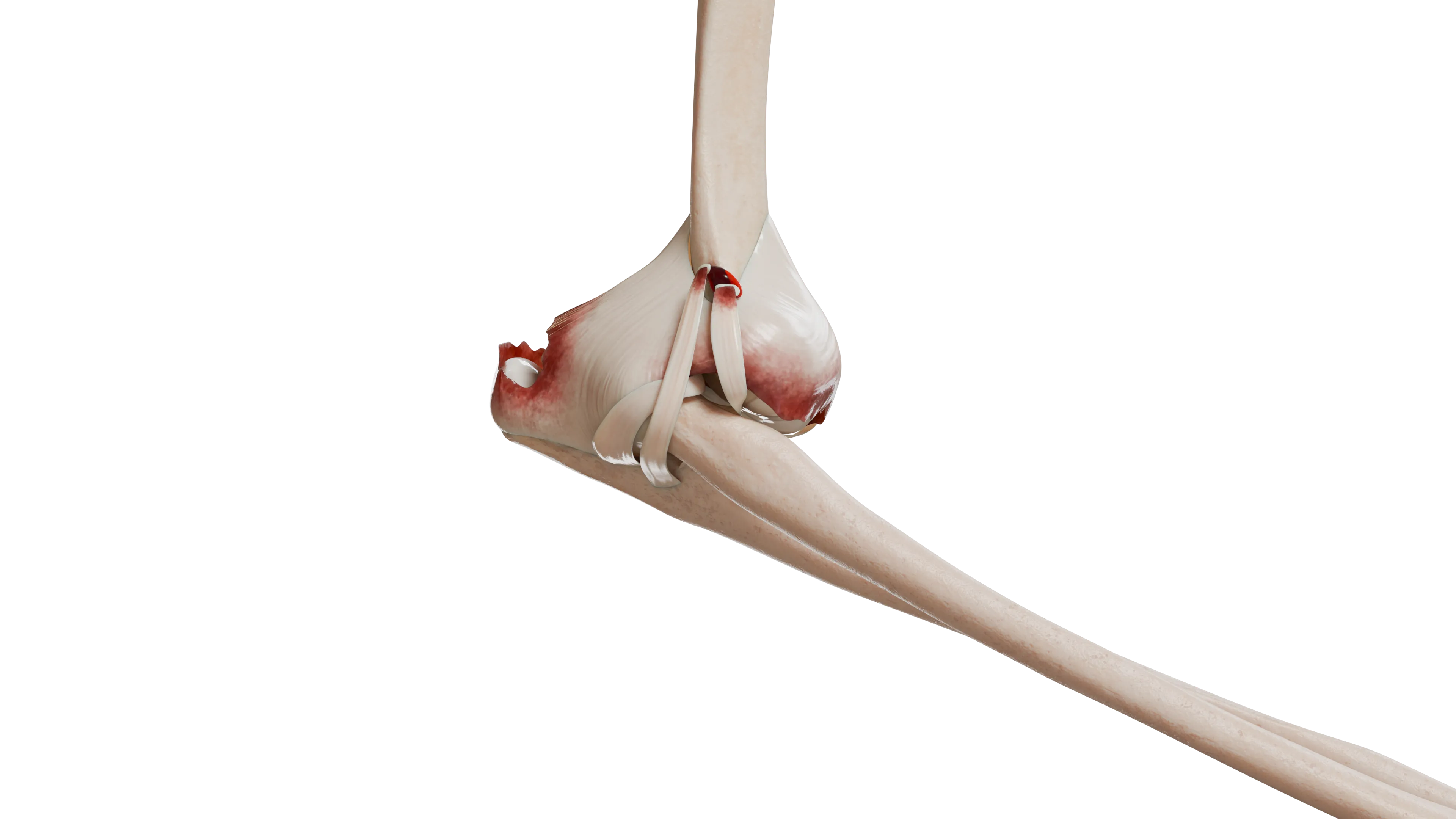 Задний вывих в локтевом суставе: смещение костей предплечья относительной плечевой кости