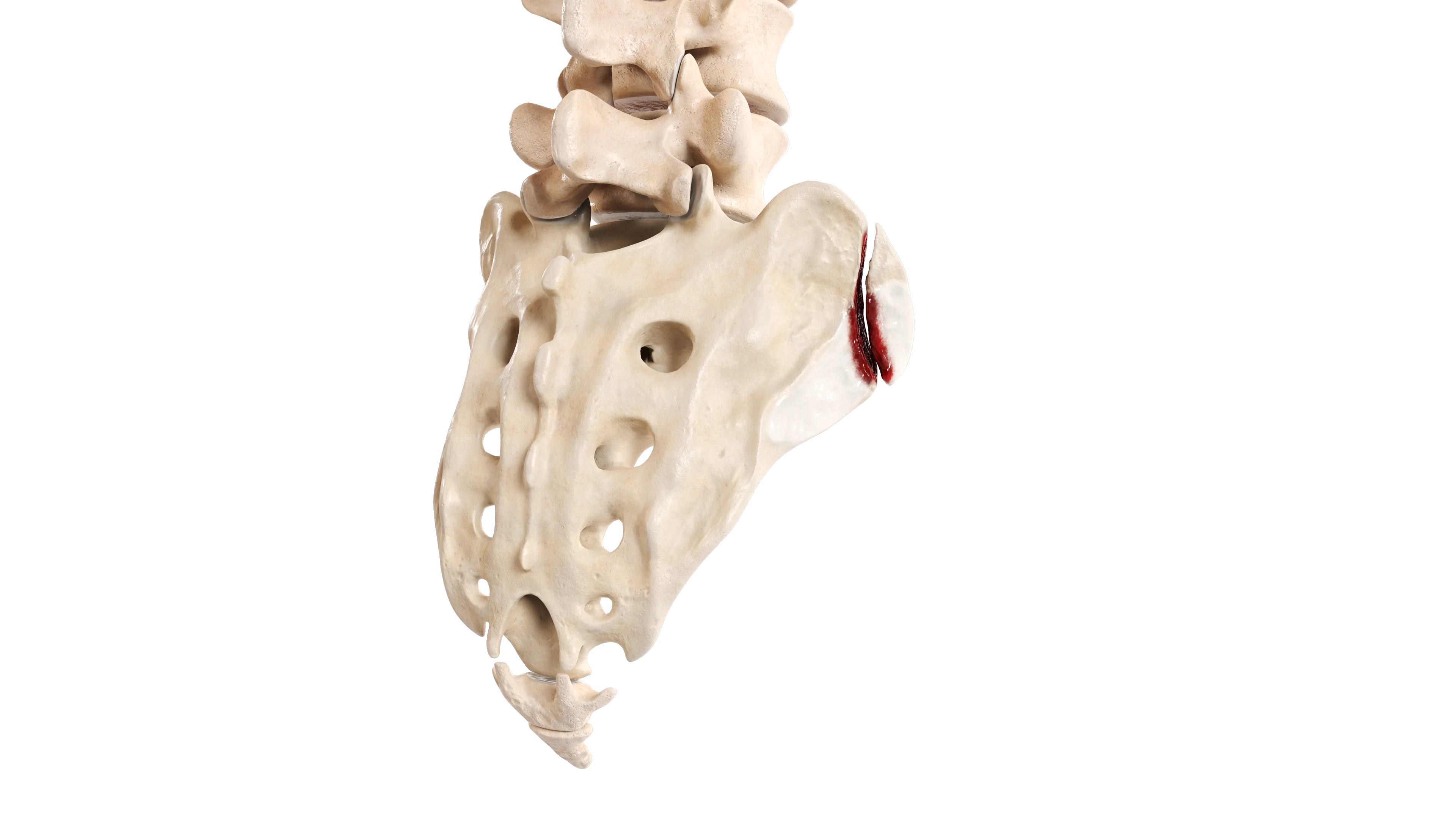 Fractures of the Sacrum: Classification, Clinical Picture, Diagnosis and Treatment