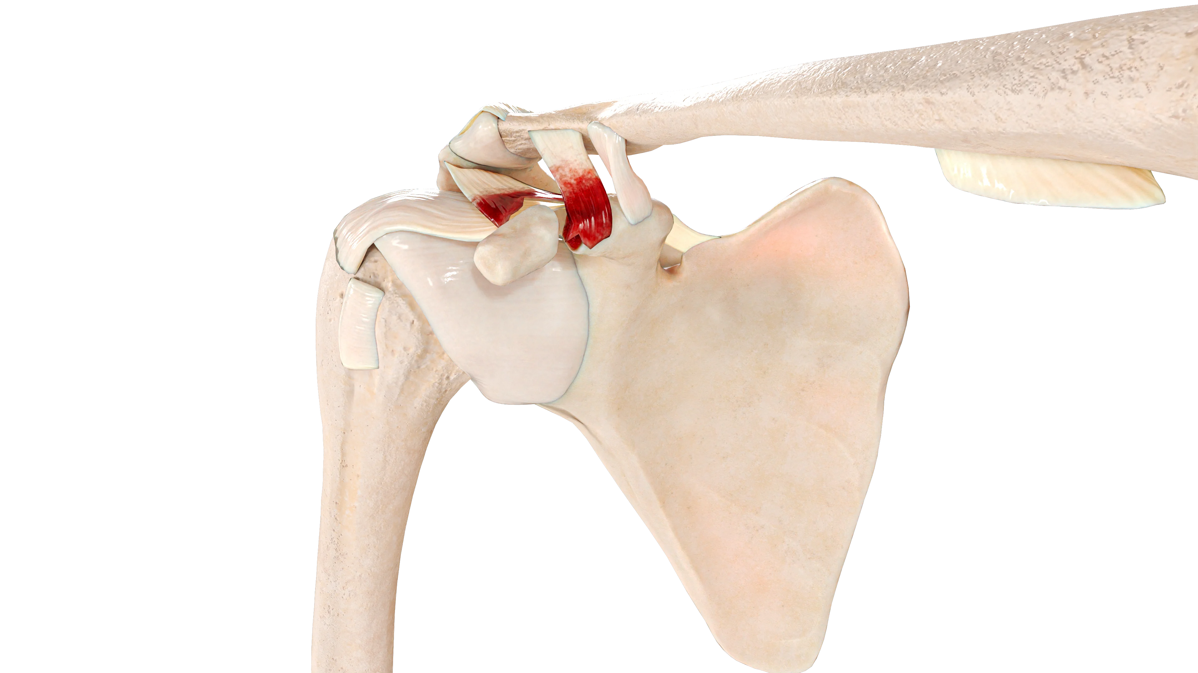 Fractura de la apófisis clavicular de la escápula (Ogawa tipo I; Eyres tipo II)
