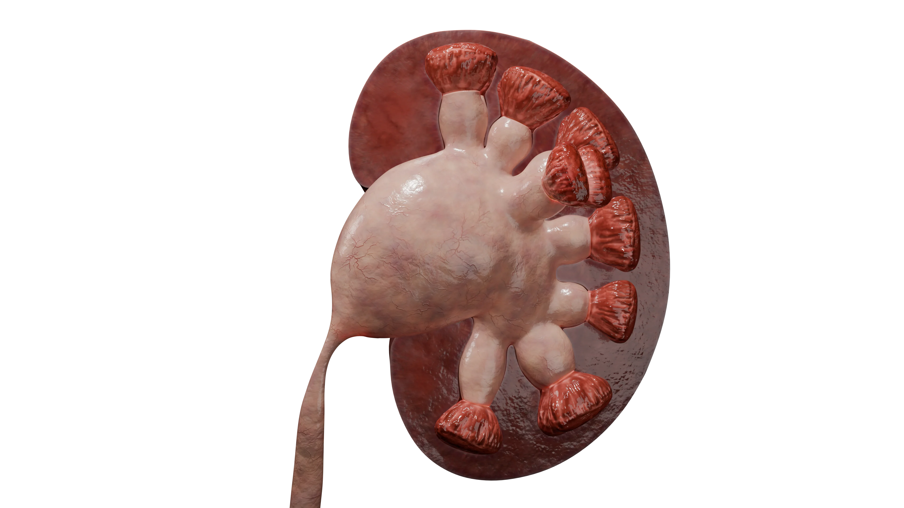 Гидронефроз: расширенная чашечно-лоханочная система с обструкцией в лоханочно-мочеточниковом сегменте