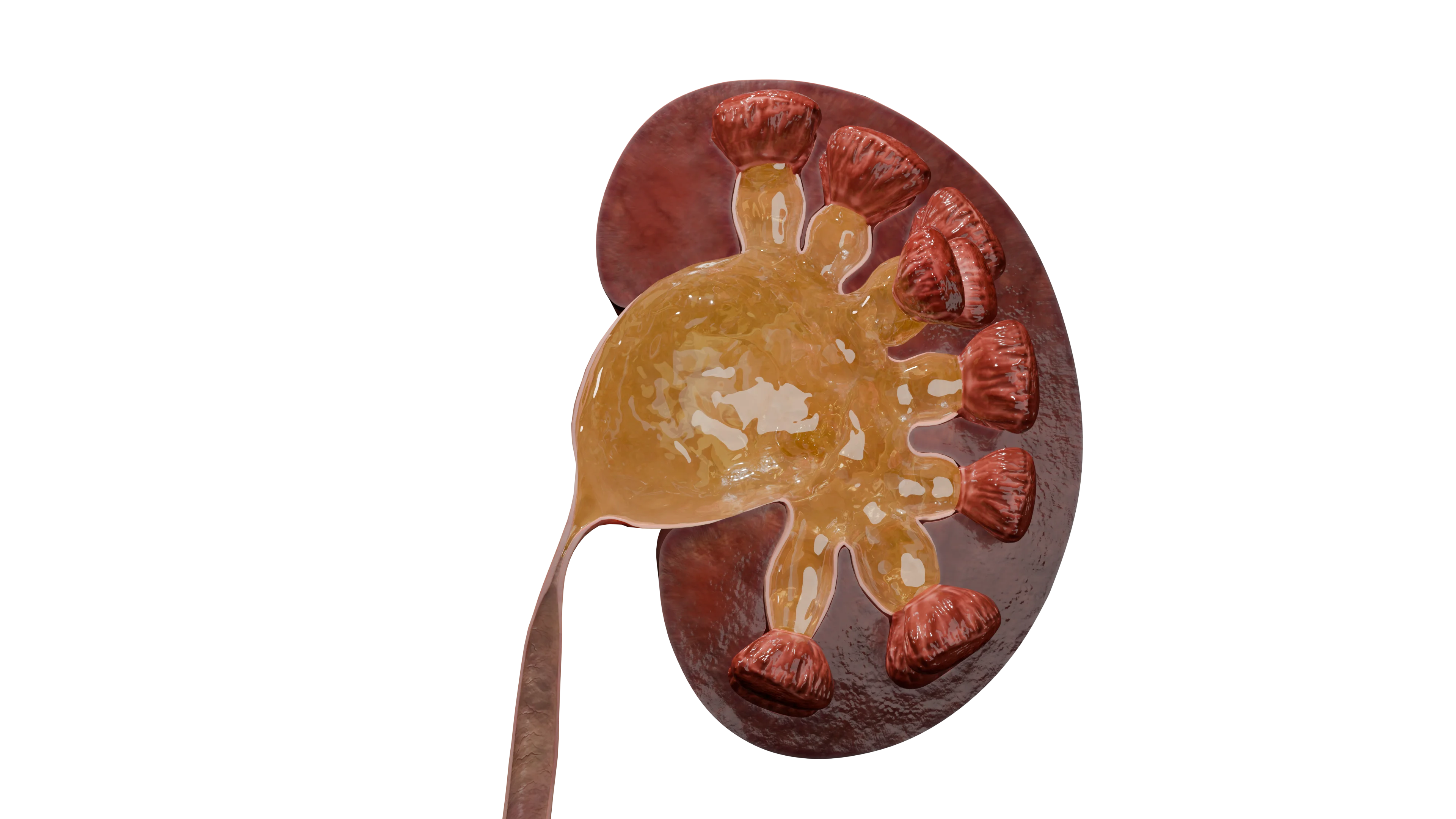 Нарушения адекватного оттока мочи из-за стриктуры в лоханочно-мочеточниковом сегменте