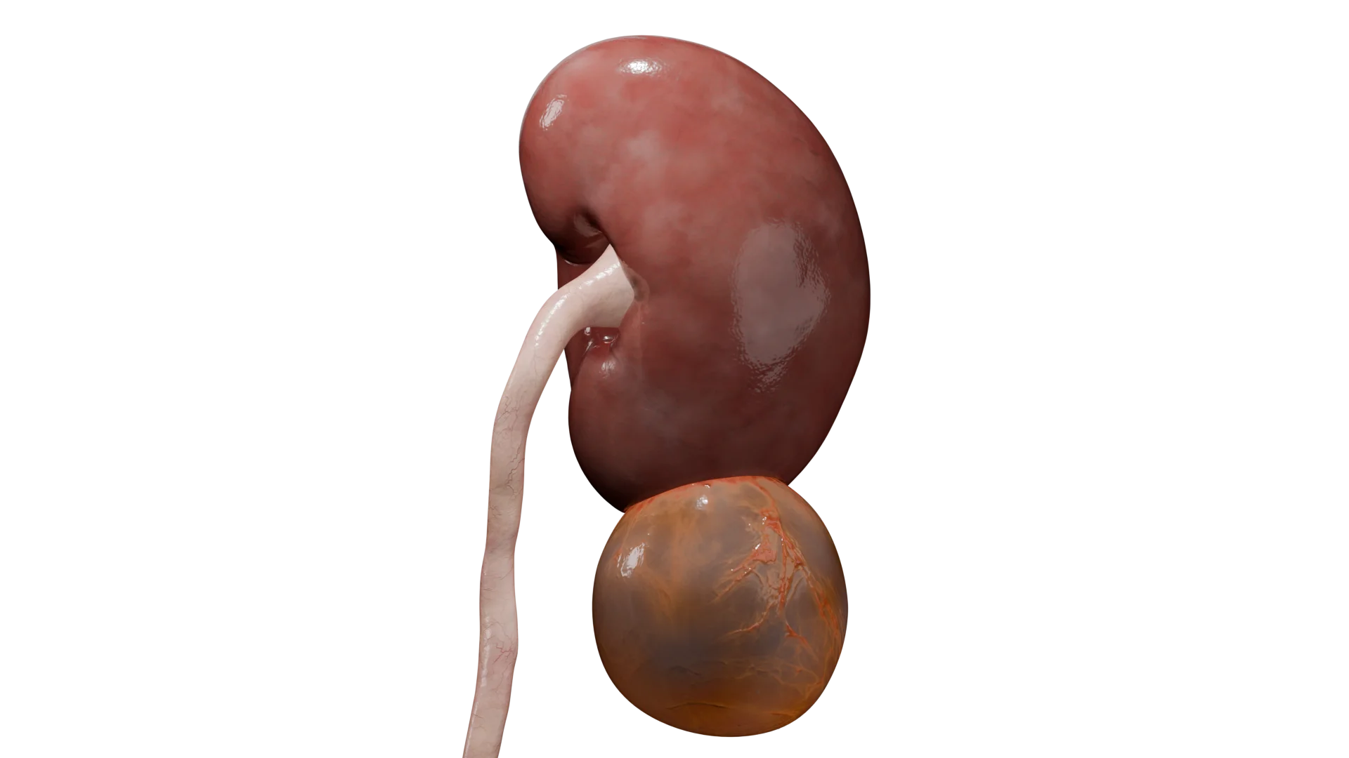 Киста почки: этиология, классификация, клиническая картина, диагностика и лечение