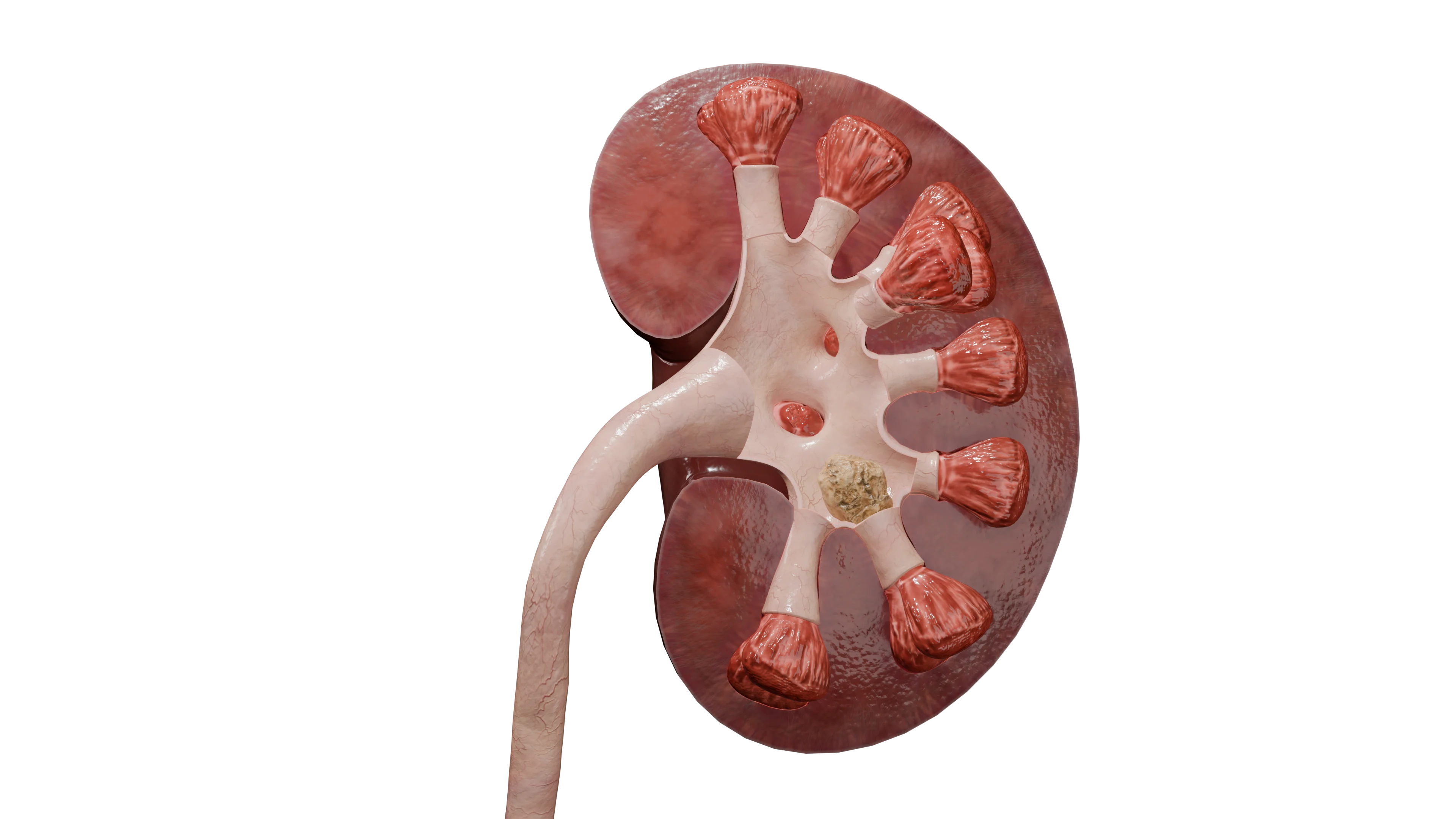 Камень левой почки