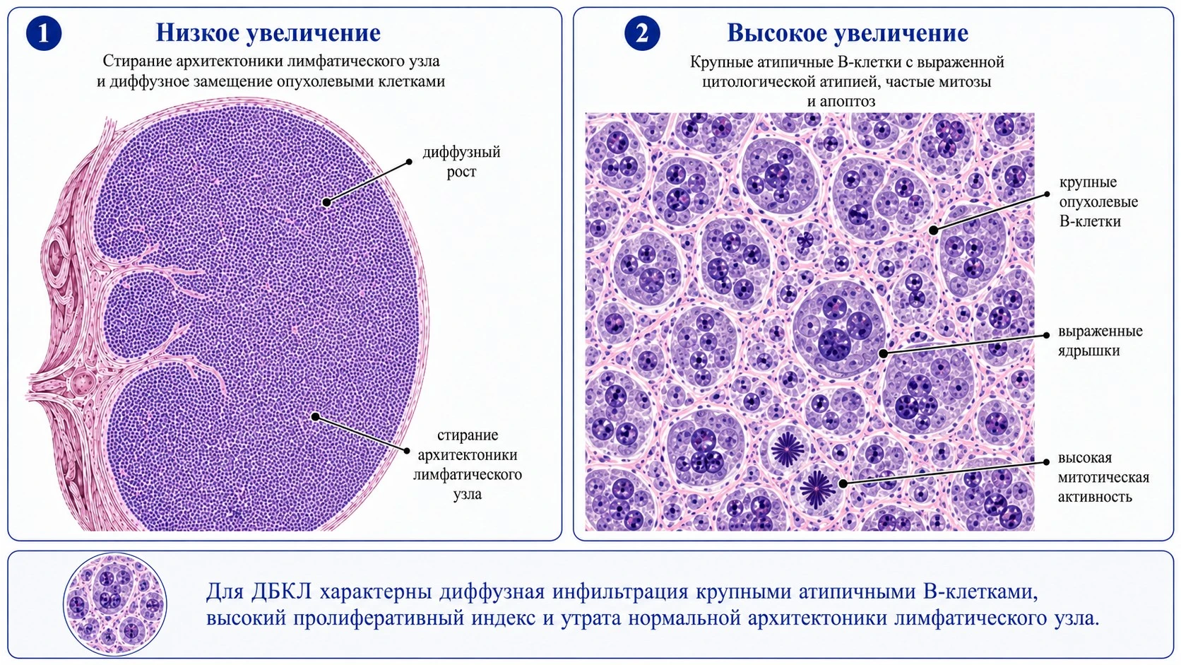 Схематическое изображение диффузной В-крупноклеточной лимфомы