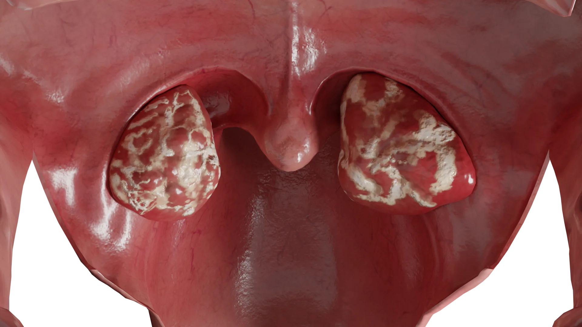 Acute Inflammatory Diseases of the Pharynx: Classification, Clinical Manifestations, Treatment
