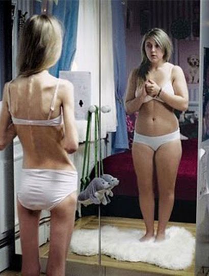 Bulimia y anorexia: Males que también llegan con la primavera