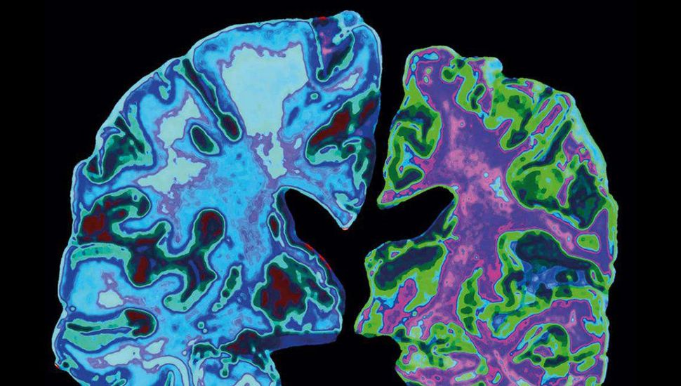 alzheimer test cognitivos