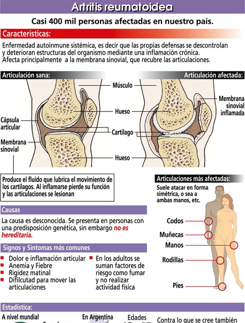 Artritis la importancia de su detección • Diario Democracia