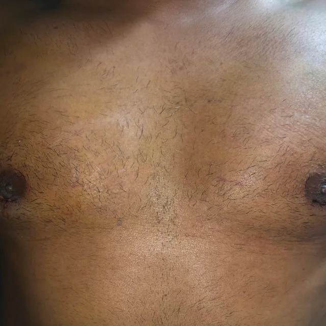gynecomastia after - patient results