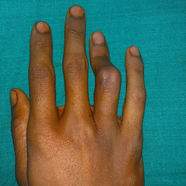hand surgery before - patient results