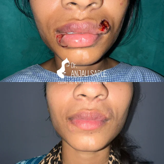 lip surgery before - patient results