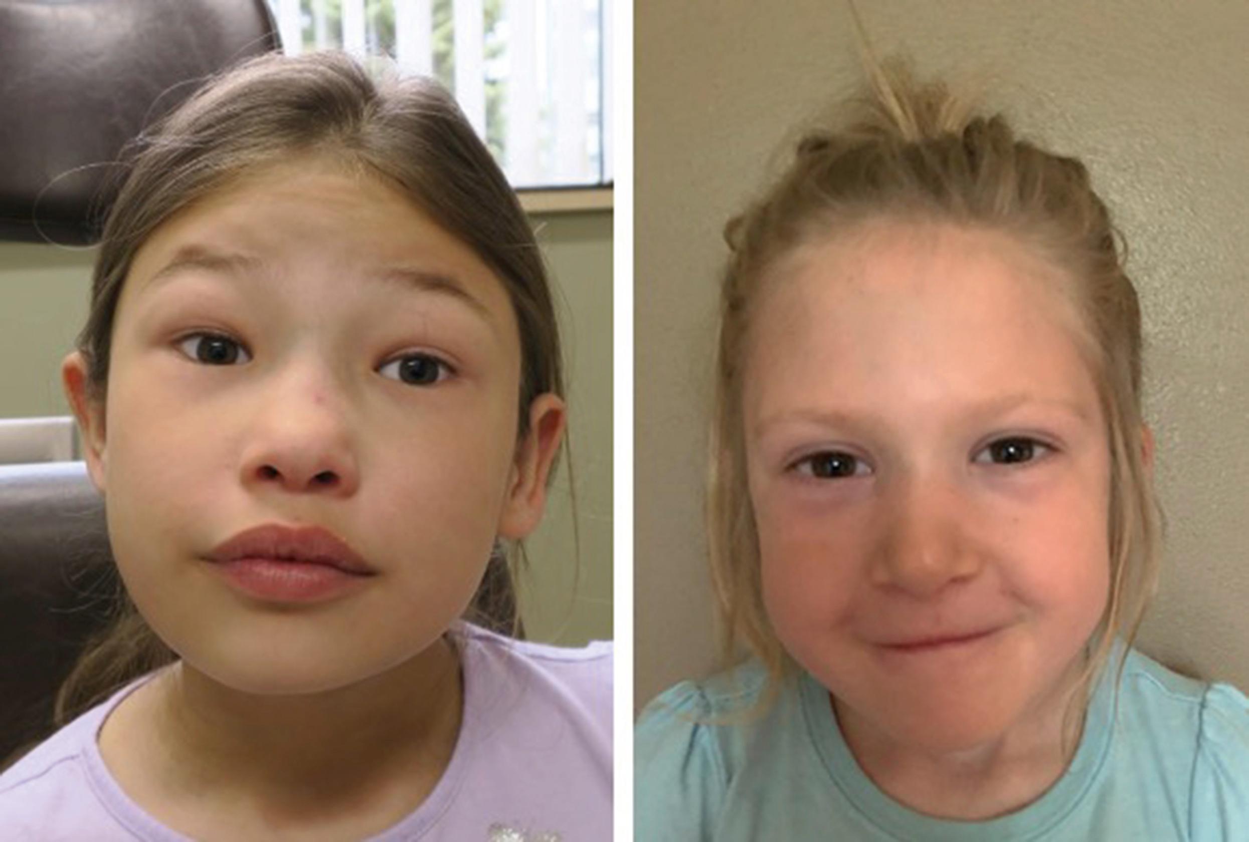 Fig. 11.1, Clinical appearance of two children with 22q11.2DS demonstrating some of the characteristic facial features.