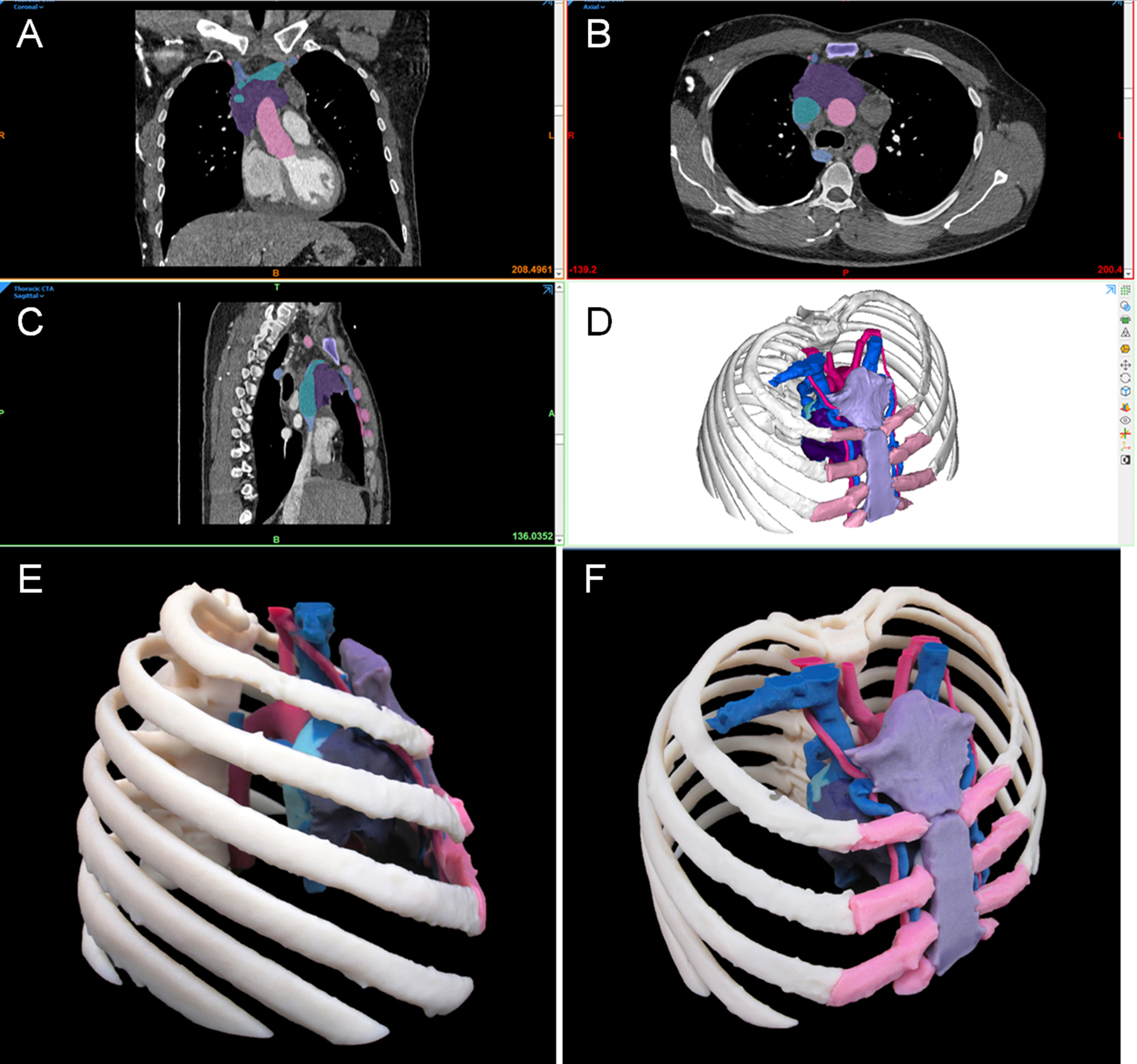 Fig. 6.1, Segmentation, CAD, and 3D printed anatomic model of adult malignant thymoma tumor. Included: thymoma tumor (dark purple), adjacent thrombus (teal), aorta (magenta), superior vena cava (dark blue), spine and ribs (white), sternum (light purple), and cartilage (pink). (A) : Coronal view of segmentation. (B) : Axial view of segmentation. (C) : Sagittal view of segmentation. (D) : Isometric view CAD model generated from segmented anatomies. (E) : Sagittal view of 3D printed anatomic model. (F) : Isometric view of 3D printed anatomic model. Mayo Clinic, Rochester, MN, USA.