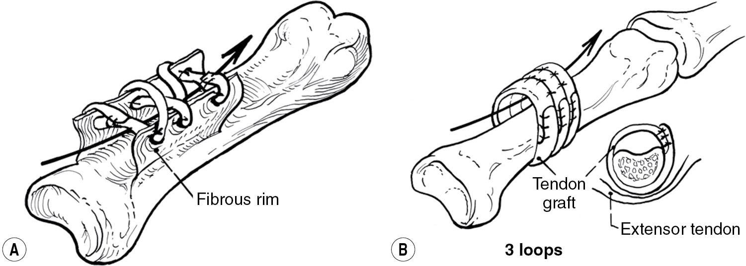 FIGURE 80.1, Diagrams of weaving the graft through pulley remnants (A), compared with a triple loop (B).