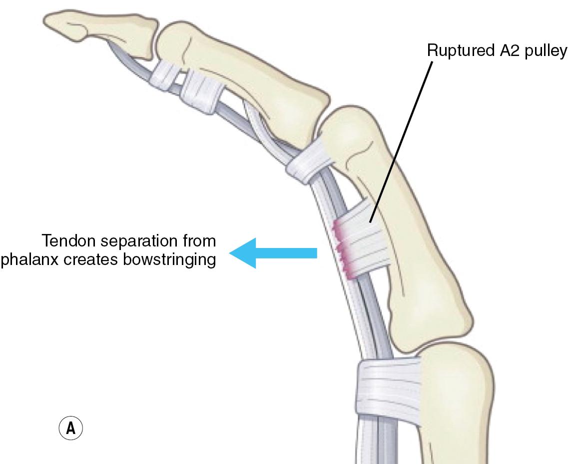 FIGURE 80.2, (A–B) Tendon bowstringing.