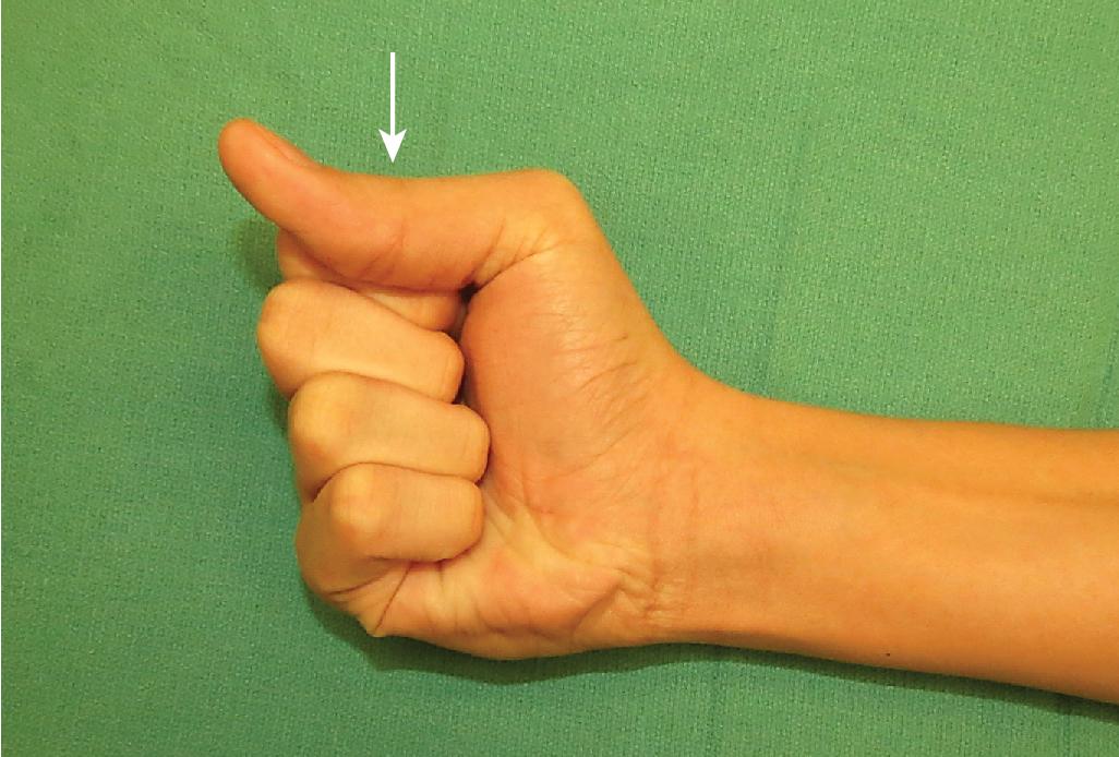 FIGURE 80.3, Limited active flexion at interphalangeal (IP) joint, indicated by arrow .