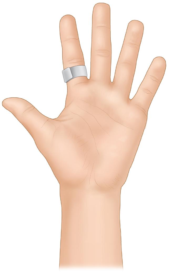 FIGURE 80.4, Orthotic ring.