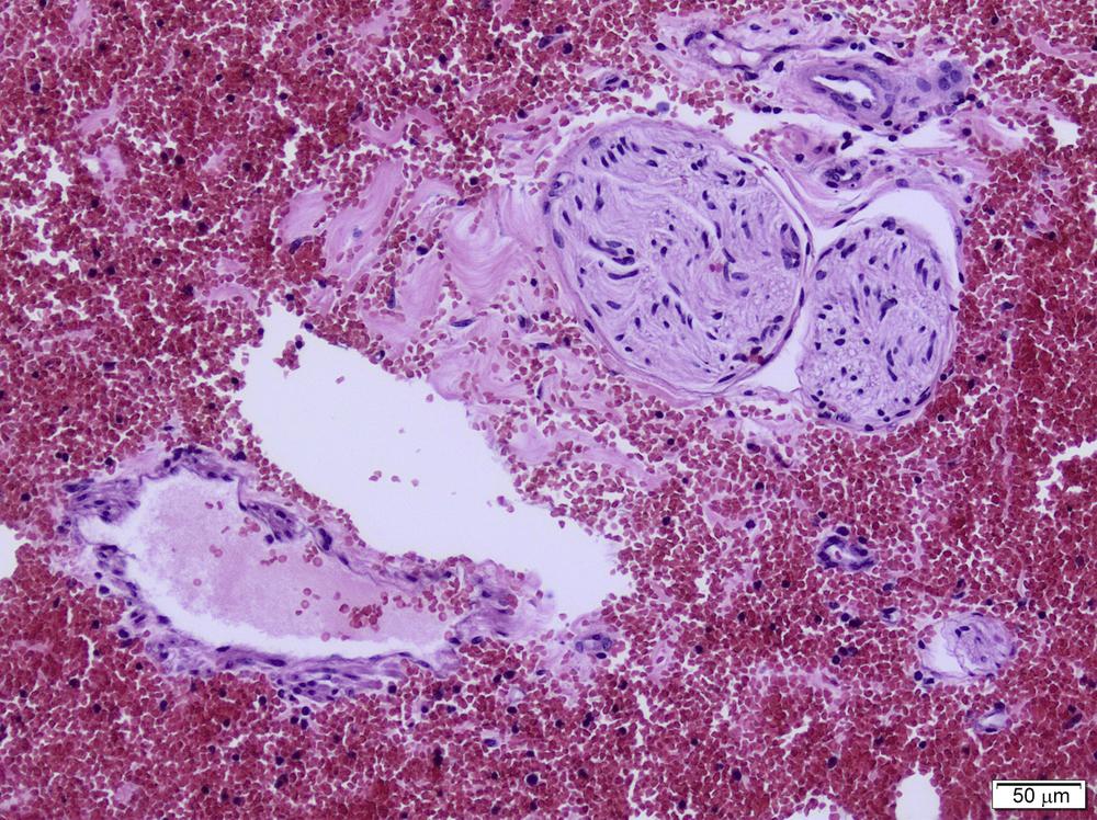 Fig. 9.2, Severe early hemorrhagic antibody-mediated rejection after ABOi liver transplantation.