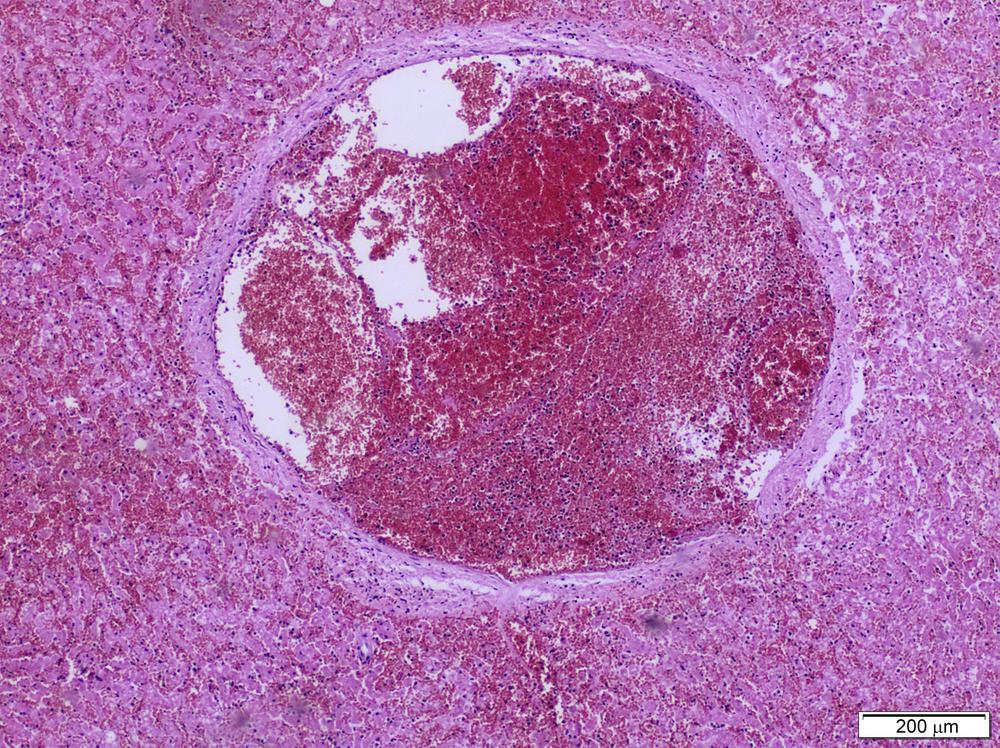 Fig. 9.3, Intrahepatic vascular thrombosis in the course of severe early antibody-mediated rejection in a patient after ABOi liver transplantation.