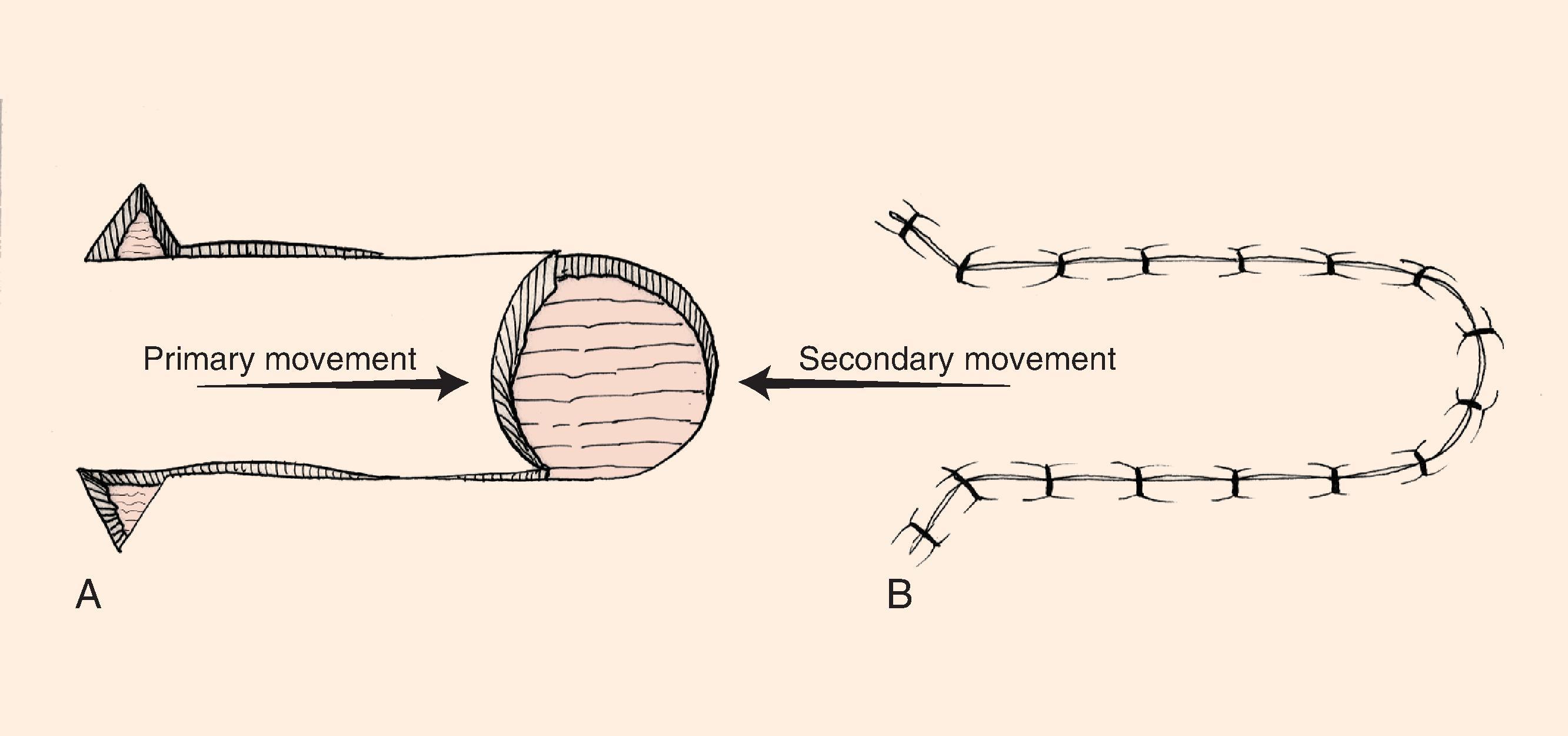 FIG. 9.1, Unipedicle advancement flap. Primary and secondary skin movement occurs with wound repair. (From Brown MD: Advancement flaps. In Baker SR, Swanson NA [eds]: Local Flaps in Facial Reconstruction. St. Louis, Mosby, 1995, p 93, Fig 1, with permission.)