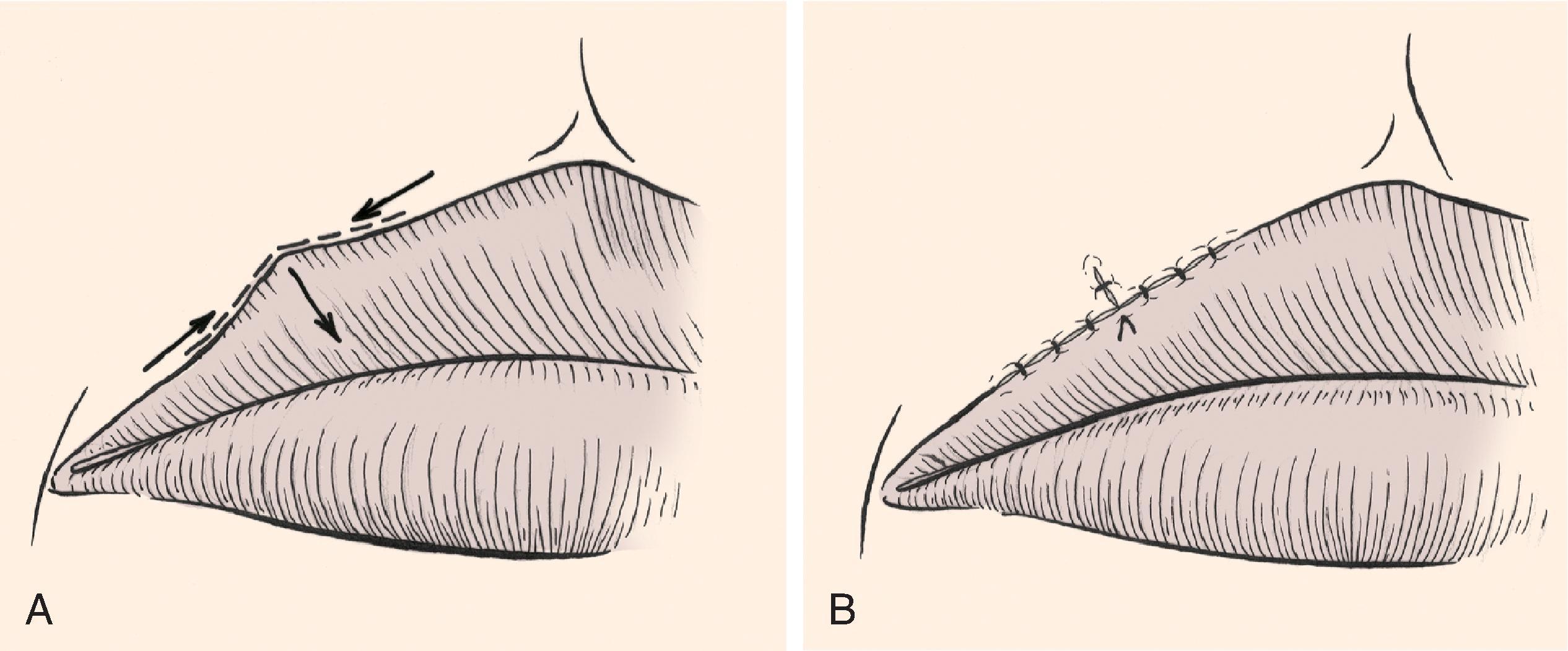 FIG. 9.11, A , B , V-to-Y advancement flap used to correct retraction of vermilion. Segment of distorted vermilion incorporated into V-shaped flap and flap advanced toward lip to restore natural topography of vermiliocutaneous border. (From Brown MD: Advancement flaps. In Baker SR, Swanson NA [eds]: Local Flaps in Facial Reconstruction . St. Louis, Mosby, 1995, p 106, Fig 15, with permission.)