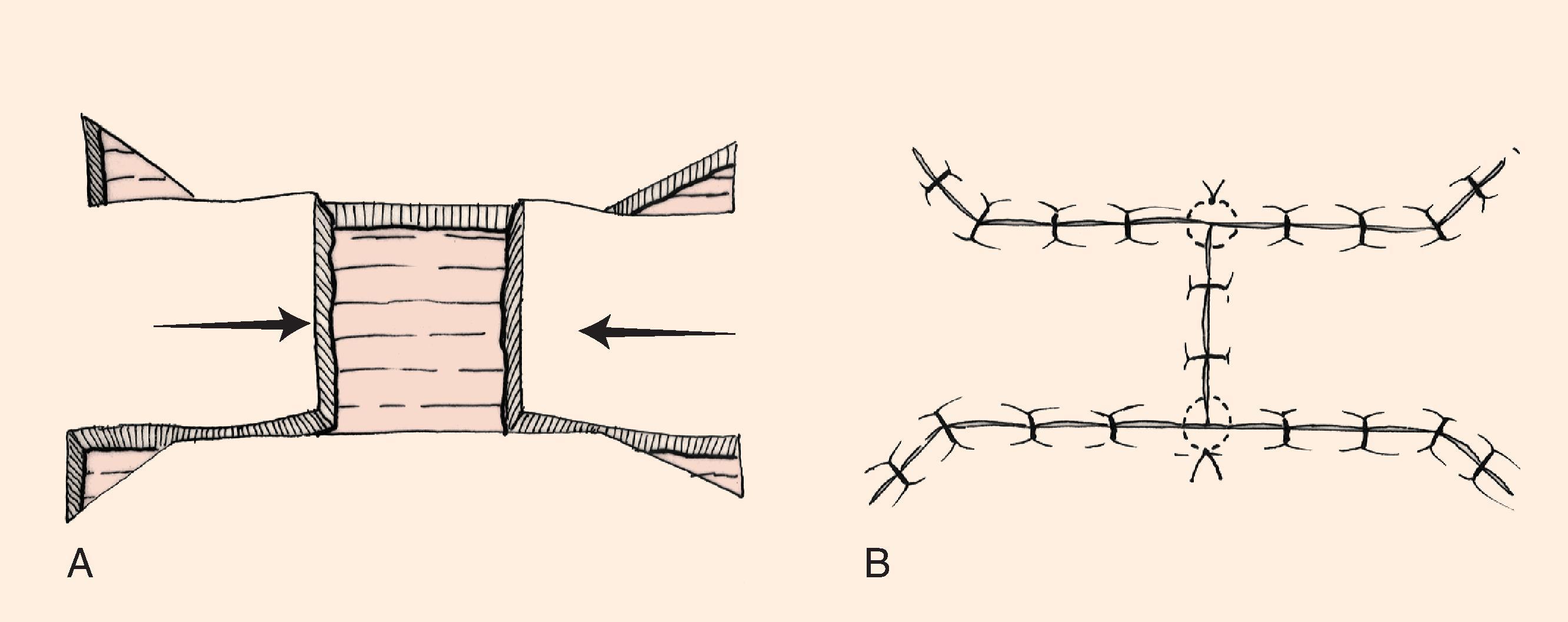 FIG. 9.3, Bilateral unipedicle advancement flaps (H-plasty). (From Brown MD: Advancement flaps. In Baker SR, Swanson NA [eds]: Local Flaps in Facial Reconstruction. St. Louis, Mosby, 1995, p 93, Fig 2, with permission.)