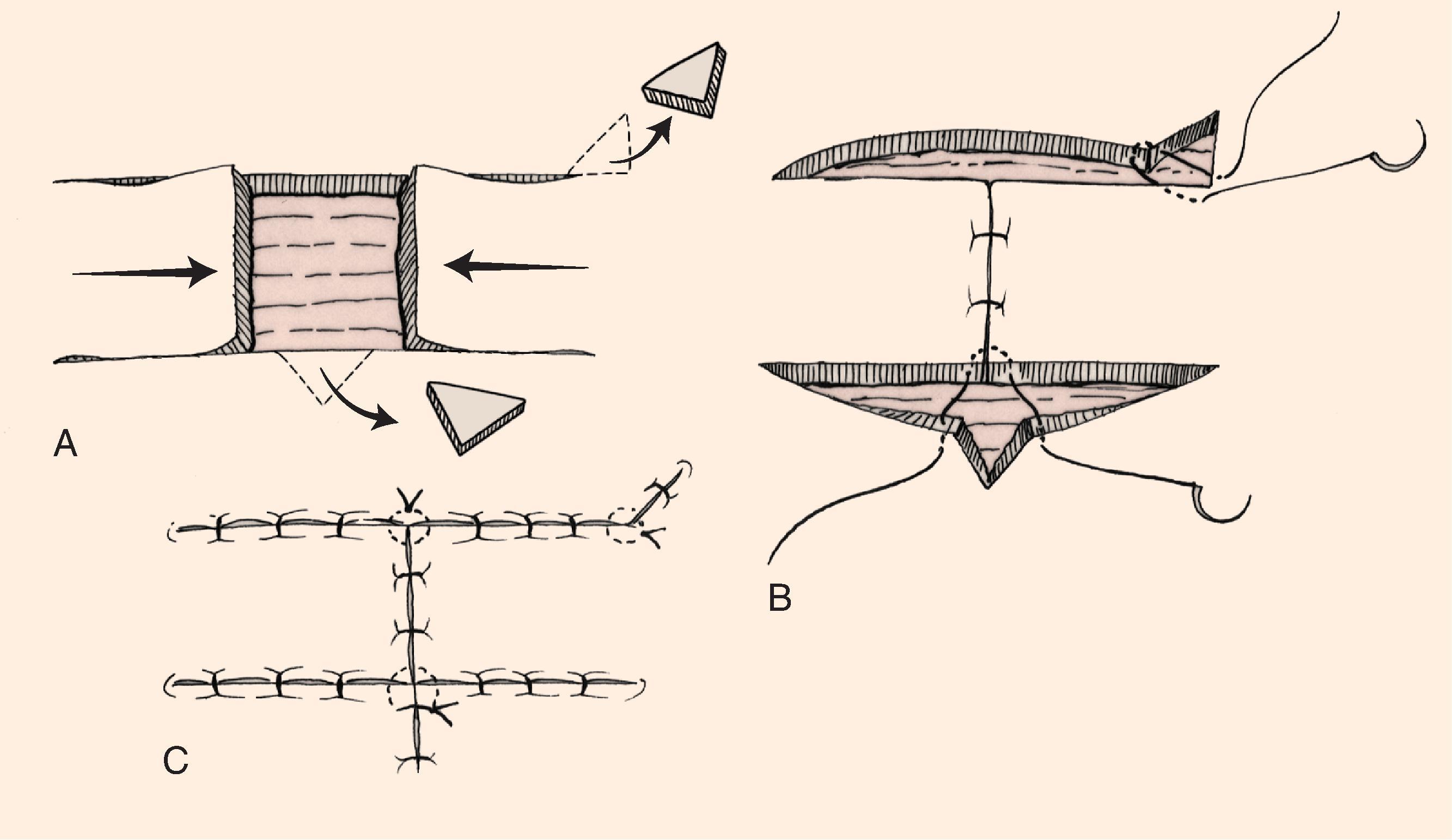 FIG. 9.4, A , H-plasty incised. B , Half-buried horizontal tip suture used to close Burow’s triangular defects. Note standing cutaneous deformity removed at different locations superior and inferior to advancement flaps. C , Epidermal closure with simple running or interrupted sutures. (From Brown MD: Advancement flaps. In Baker SR, Swanson NA [eds]: Local Flaps in Facial Reconstruction . St. Louis, Mosby, 1995, p 94, Fig 3, with permission.)