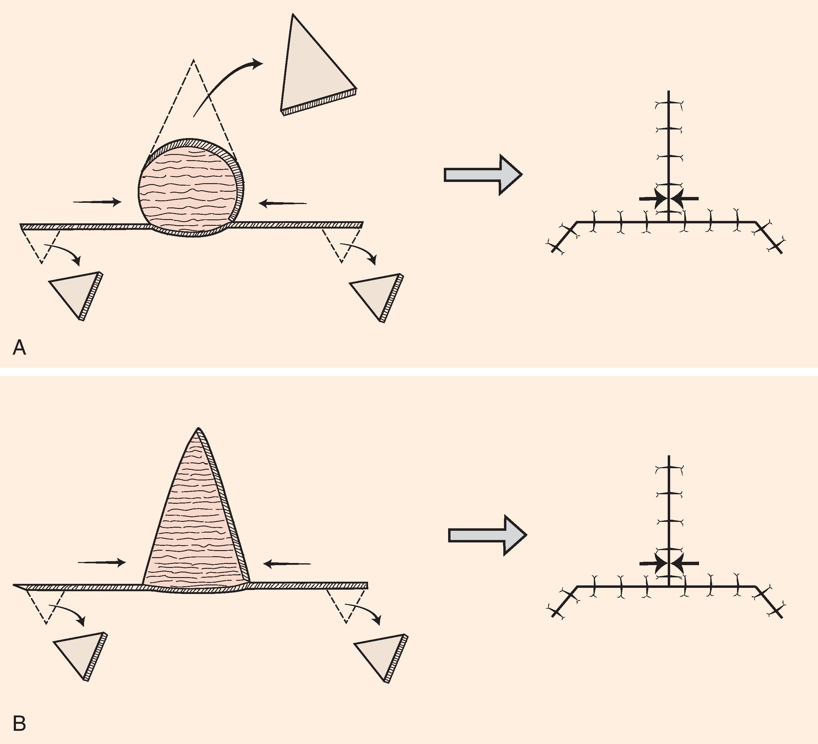 FIG. 9.5, A , O-to-T (T-plasty) repair of circular (O-shaped) wound. T-plasty requires two flaps advanced in opposite directions toward each other. Standing cutaneous deformity forming superiorly from advancement excised at vertical limb of T. B , A-to-T (T-plasty) repair of triangular (A-shaped) wound. Wound closure suture line has T-shaped configuration. Opposing arrows indicate point of greatest wound closure tension.