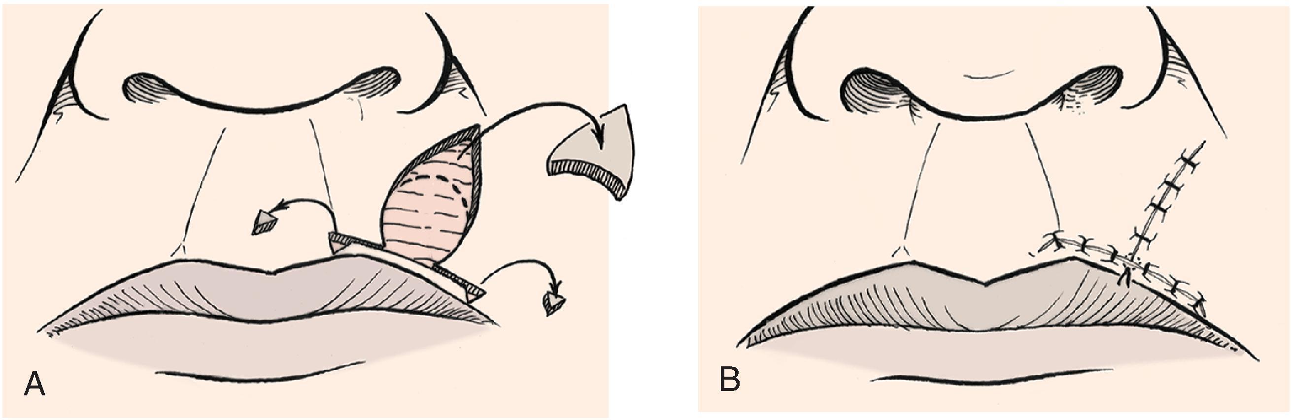 FIG. 9.6, A , O-to-T (T-plasty) repair of circular defect of upper lip near vermiliocutaneous border. B , T-shaped wound closure avoiding incisions into vermilion. (From Brown MD: Advancement flaps. In Baker SR, Swanson NA [eds]: Local Flaps in Facial Reconstruction. St. Louis, Mosby, 1995, p 97, Fig 6, with permission.)