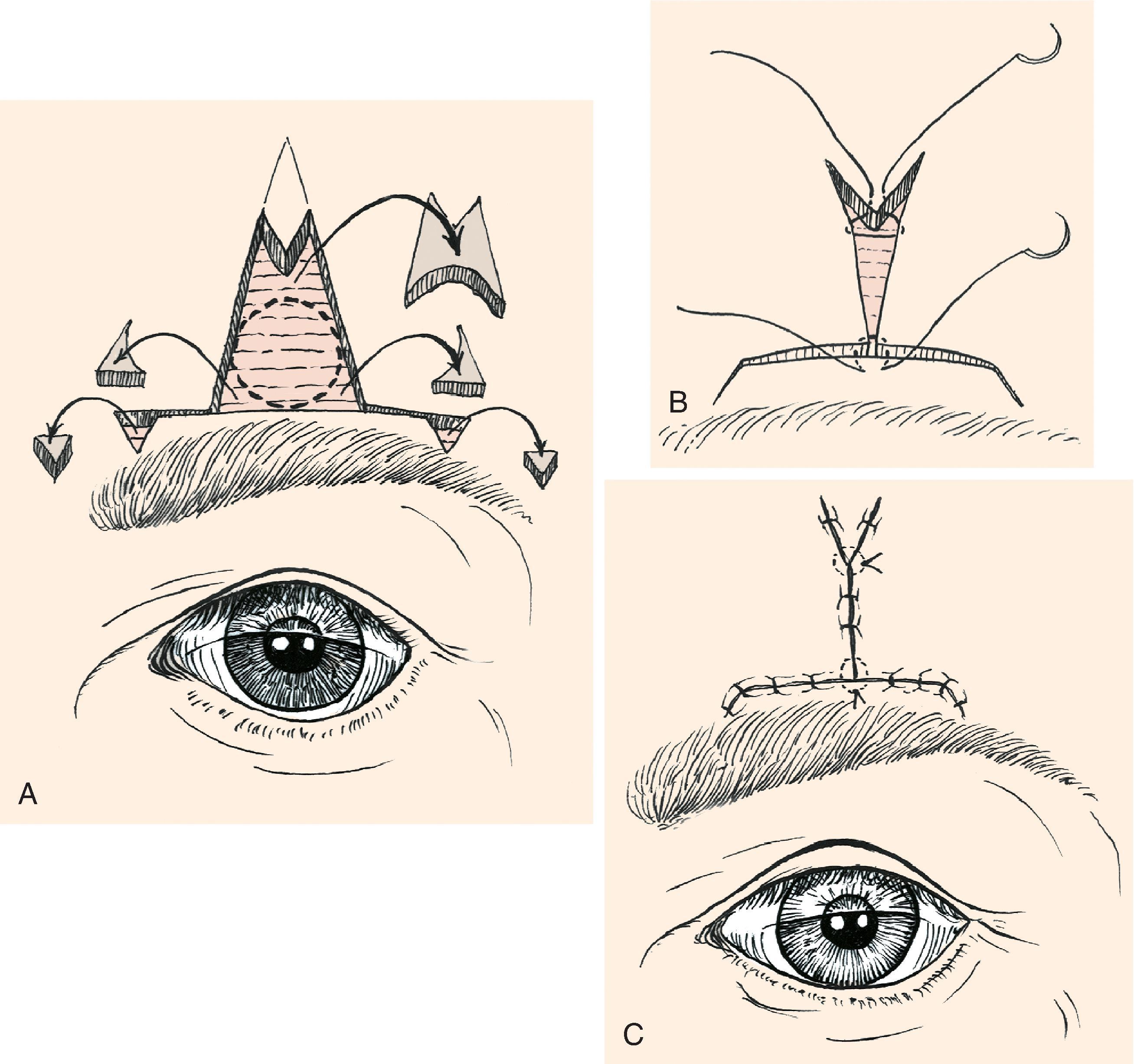 FIG. 9.7, A , O-to-T (T-plasty) repair of circular skin defect near eyebrow. Wedges of skin removed from perimeter of circle. Superiorly, M-plasty limits vertical scar length. Burow’s triangles removed at end of horizontal limb of flaps. B , Half-buried horizontal mattress tip sutures. C , Wound closure with M-plasty avoids distortion of eyebrow. (From: Brown MD: Advancement flaps. In Baker SR, Swanson NA [eds]: Local Flaps in Facial Reconstruction . St. Louis, Mosby, 1995, p 98, Fig 7, with permission.)