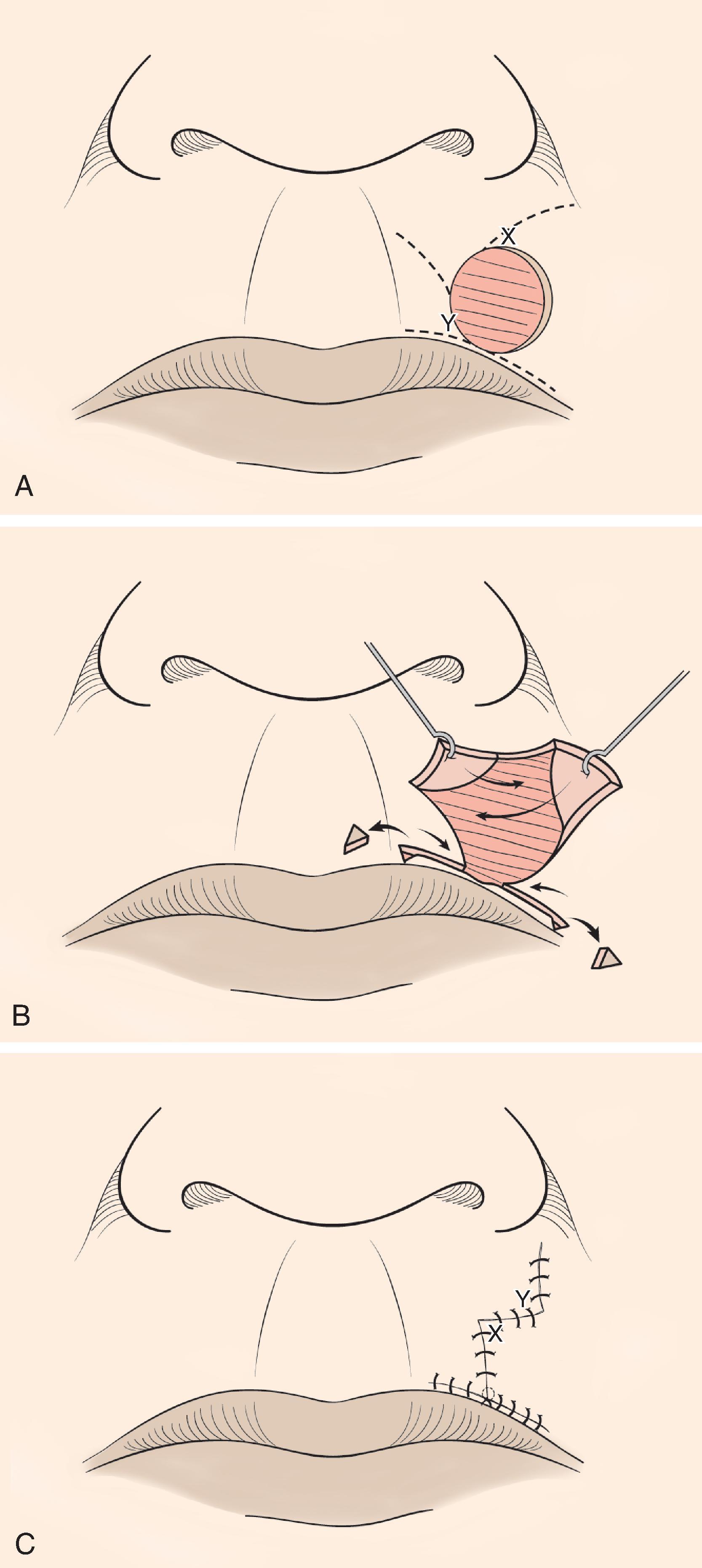 FIG. 9.8, A , Modified O-to-T (T-plasty) repair of circular cutaneous defect of upper lip. Inferior broken lines indicate incisions to create advancement flaps as part of classical T-plasty repair. Superior broken lines indicate incisions to create transposition flaps for modified Z-plasty, which eliminates need to excise standing cutaneous deformity superiorly. B , Flaps incised and dissected, small standing cutaneous deformities excised from vermilion border. C , Wound repaired. Vertical component of scar has Z configuration.
