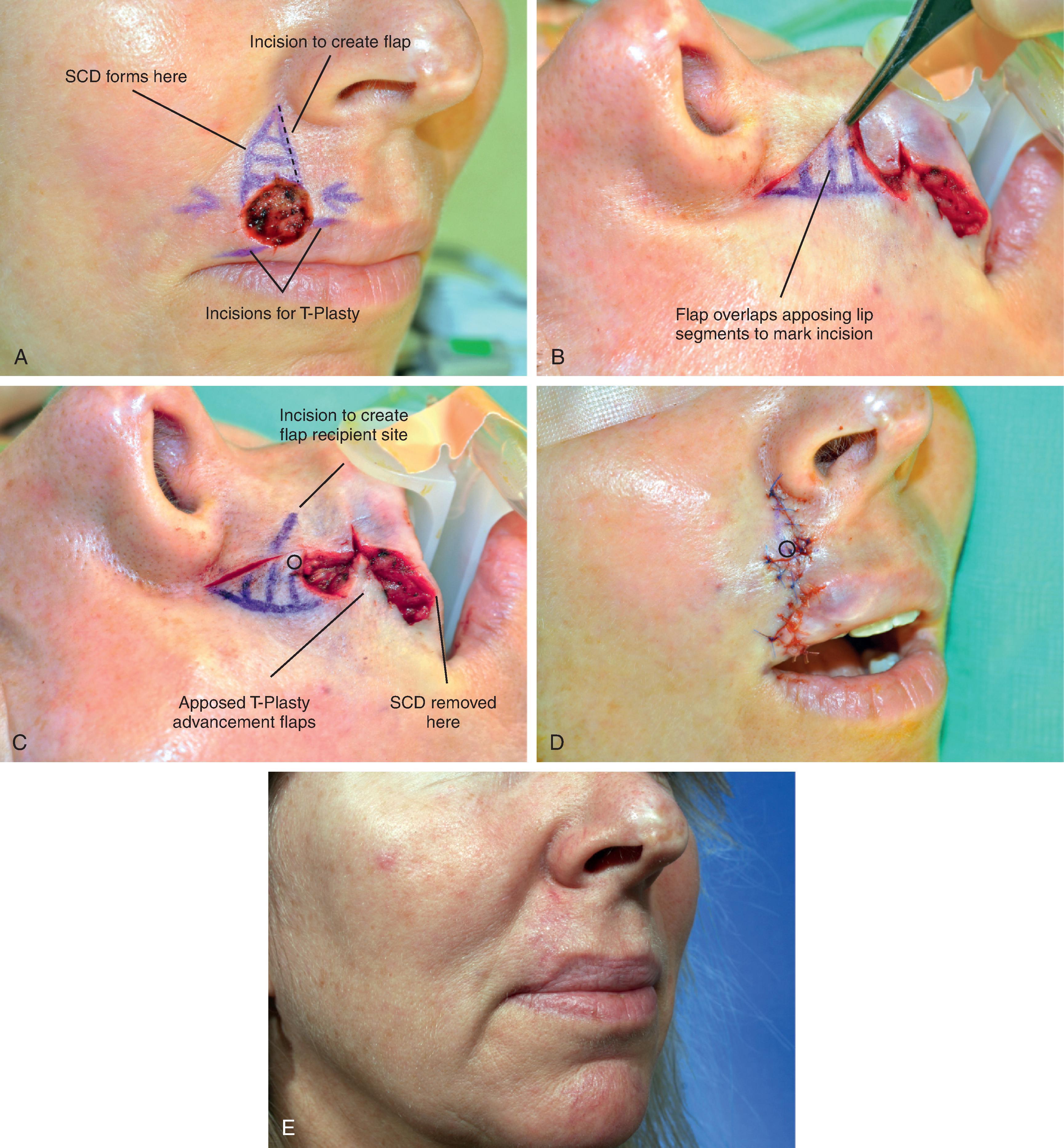 FIG. 9.9, A , A 1.5 × 1.2 cm circular cutaneous defect. Modified T-plasty designed for wound repair. Broken line indicates planned incision along border of anticipated standing cutaneous deformity (SCD). B , Flap created by incision marked by broken line in A overlaps medial lip segment to mark incision for recipient site. C , Incision marked to create recipient site for flap. Distal tip of flap marked with circle. D , Flap transposed to create modified Z-plasty vertical wound repair. Circle marks distal end of flap. E , Two months postoperative.