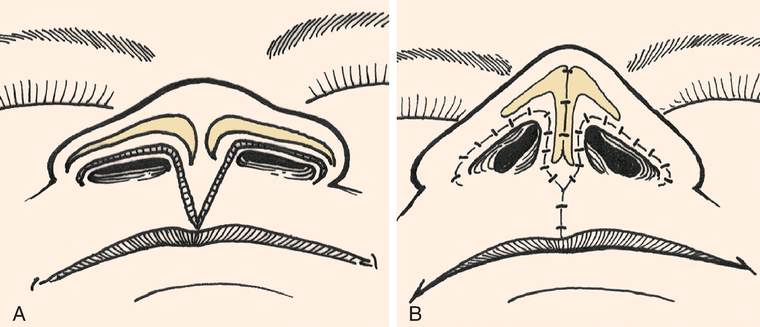 FIG. 9.10, A , B , V-to-Y advancement flap dissected from philtrum by recruiting skin from midportion of lip between philtral ridges. Length of columella augmented by advancement of flap superiorly into base of columella. (From Brown MD: Advancement flaps. In Baker SR, Swanson NA [eds]: Local Flaps in Facial Reconstruction . St. Louis, Mosby, 1995, p 106, Fig 14, with permission.)