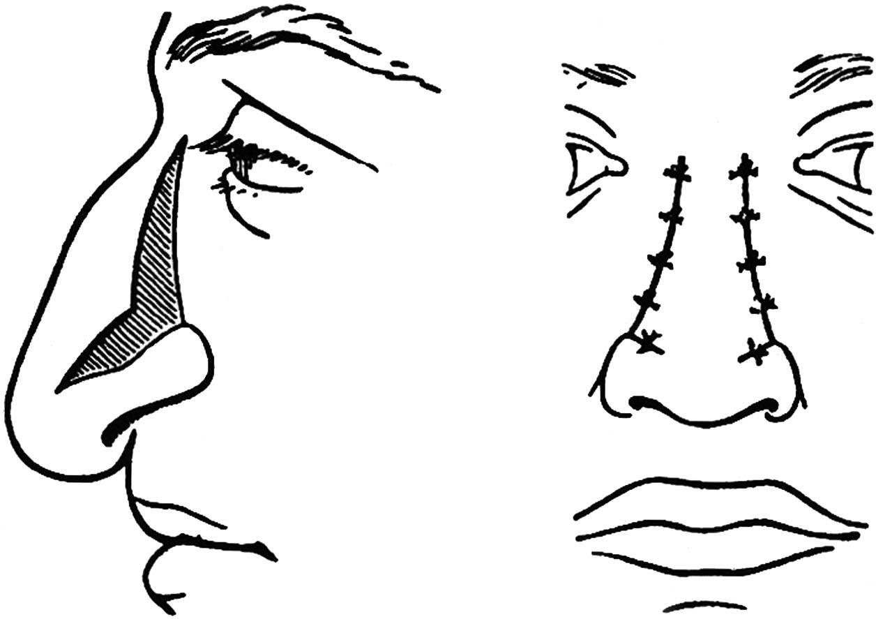 Figure 1-1, Dieffenbach's method of external excisions to alter the size of the nose.