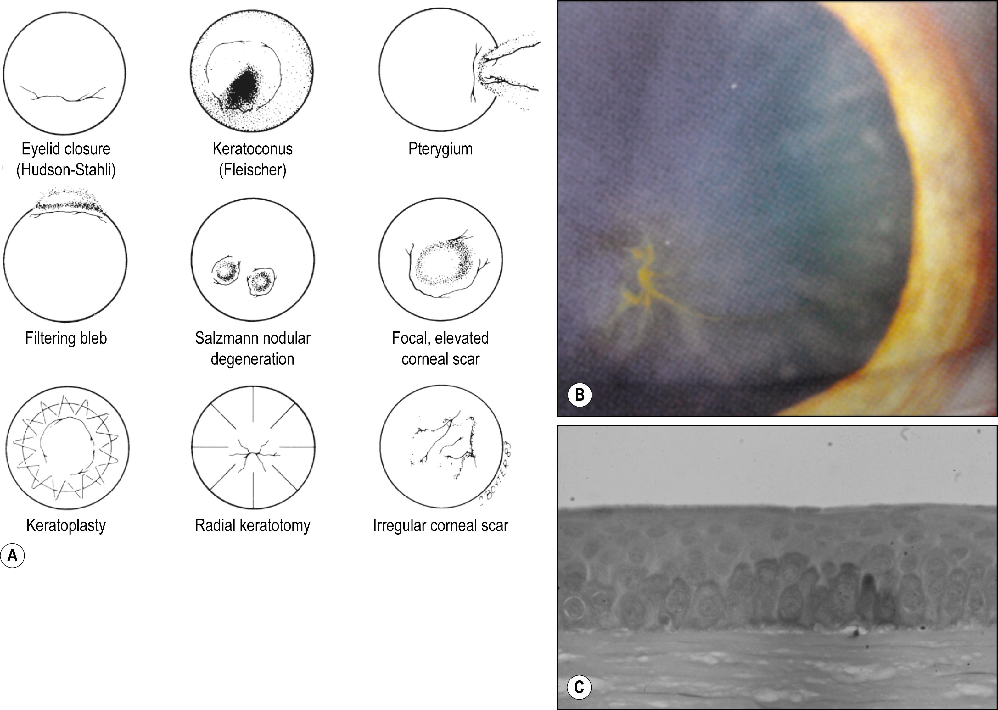 Fig. 5.4, ( A ) Nine types of iron lines in the corneal epithelium. ( B ) Irregular epithelial iron line with whorl-shaped brownish deposits in Fuchs dystrophy with chronic corneal edema and an irregular epithelial surface. ( C ) Histopathology demonstrates dark stain of iron deposits in the basal layer of corneal epithelium.