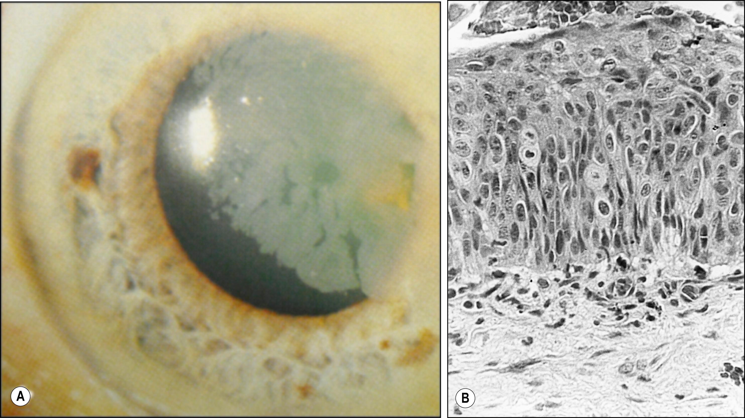 Fig. 5.5, ( A ) Corneal intraepithelial neoplasia. A flat limbal mass extends onto the cornea as a gray, opaque sheet with a sharply marginated, fimbriated leading edge. ( B ) Histopathology demonstrates thickened epithelium with loss of normal maturation and basilar neoplastic cells.